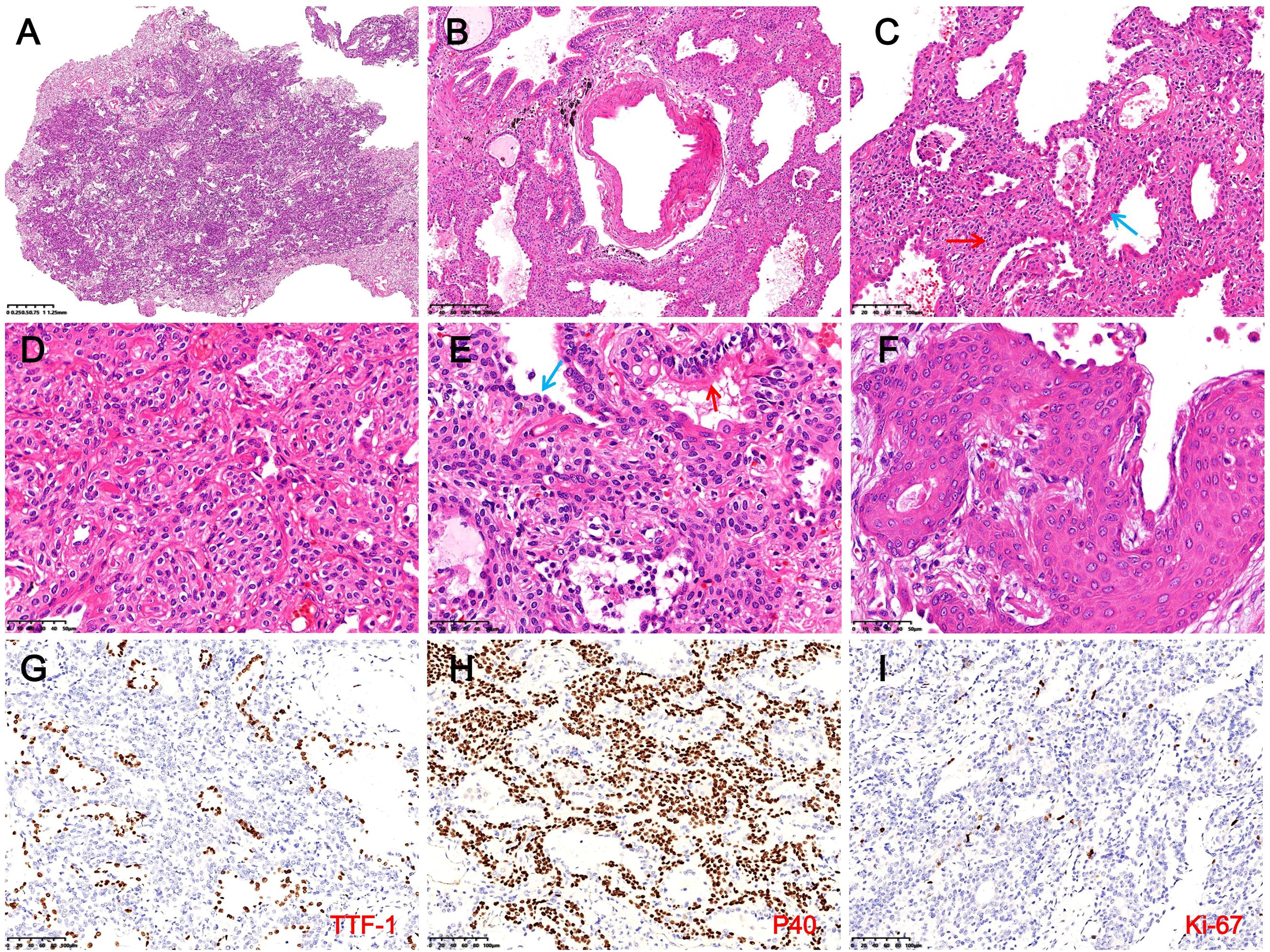 Histological images labeled A to I: A shows a broad tissue section; B, C, D, E, and F feature closer views with cellular structures visible, some marked by colored arrows; G, H, and I display stained samples with dark brown markings, indicating immunohistochemistry results for TTF-1, P40, and KI-67 respectively.