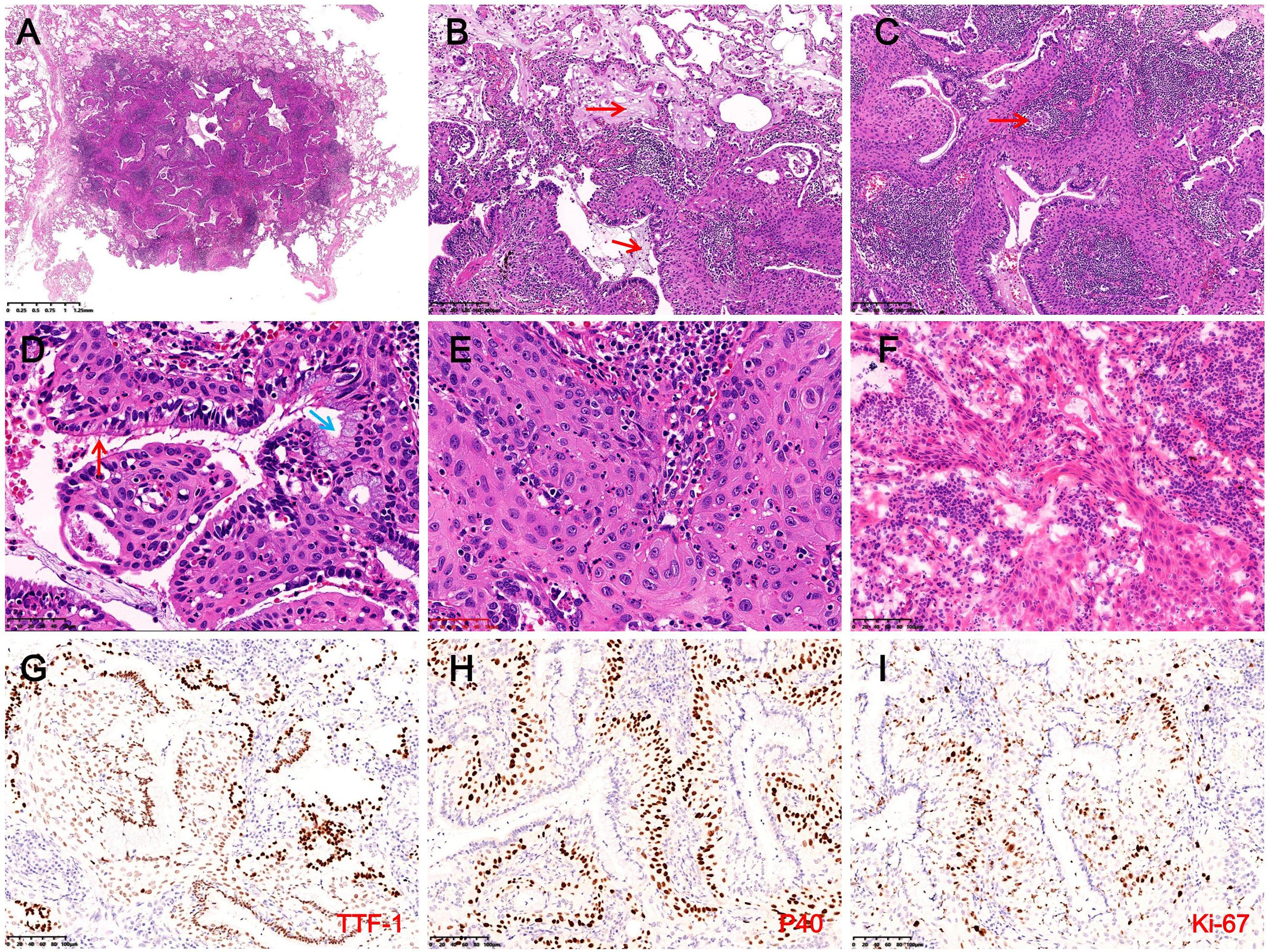 Composite image showing histological and immunohistochemical analyses. Panels A to F display various magnifications of tissue sections stained with hematoxylin and eosin, highlighting structural and cellular details. Panels G to I show immunohistochemical stains for TTF-1, p40, and Ki-67, respectively, indicating protein expression with brown staining in cells, used to assess tissue differentiation and proliferation.
