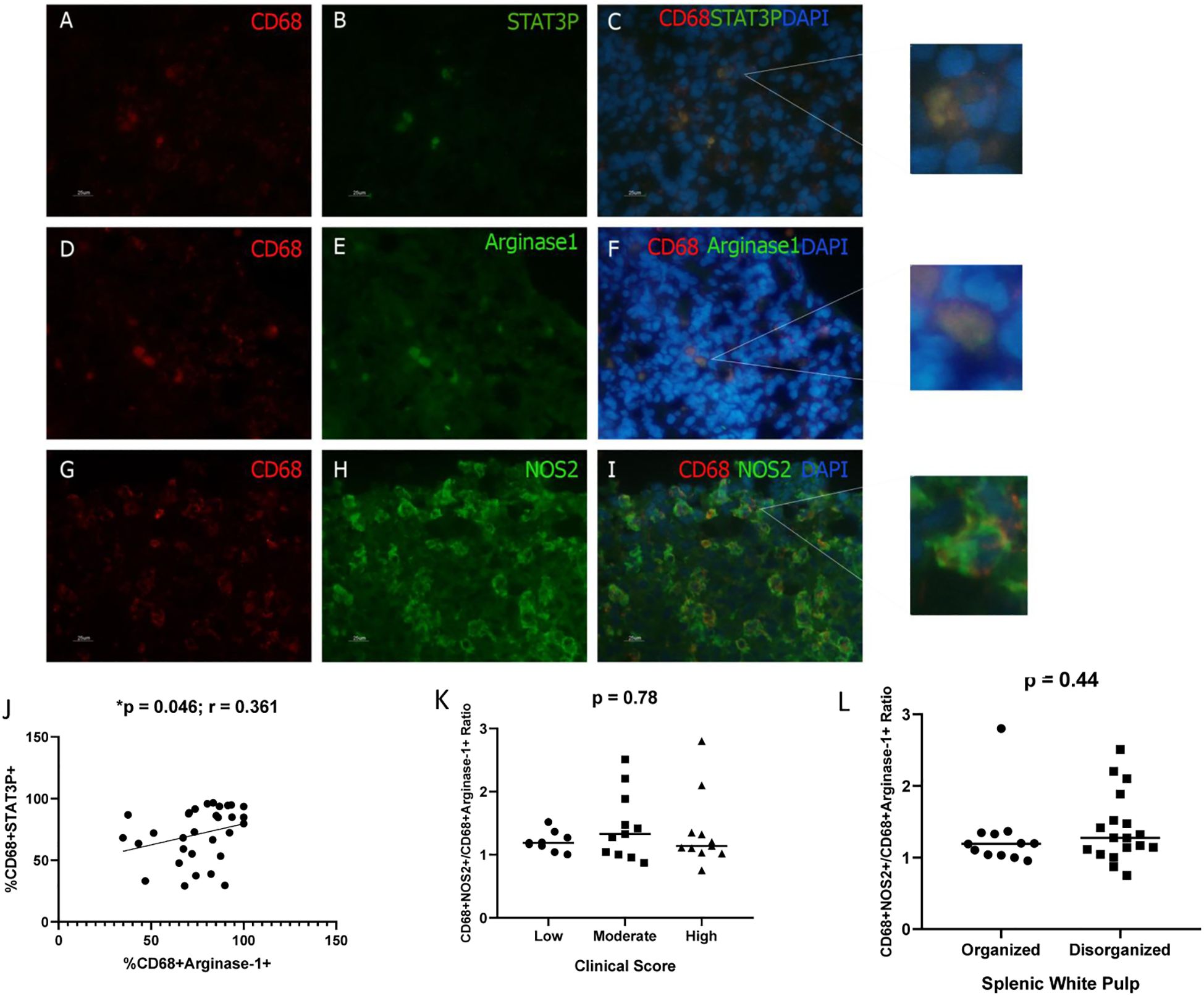 Fluorescence microscopy images show DAPI-stained cells expressing CD68 in red and co-stained with STAT3P, Arginase 1, and NOS2 in green. Panels A-C highlight CD68 and STAT3P, D-F show CD68 and Arginase 1, while G-I display CD68 and NOS2. Small insets provide zoomed views of marked regions. Graph J presents a scatter plot of %CD68+STAT3P+ cells versus %CD68+Arginase+1+. Graph L shows CD68+NOS2+/CD68+Arginase+1+ ratio across clinical scores, and Graph M compares the ratio in organized versus disorganized splenic white pulp. Statistical significances are indicated with p-values.