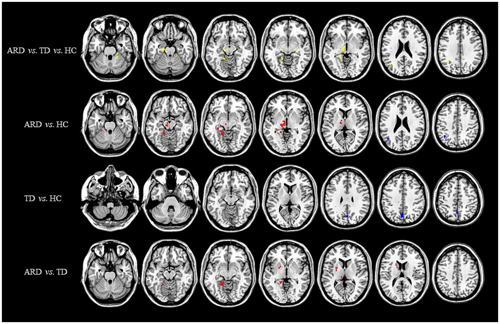 A grid of brain MRI scans comparing different conditions: ARD vs. TD vs. HC, ARD vs. HC, TD vs. HC, and ARD vs. TD. Each row depicts cross-sectional brain images with color-coded highlights indicating areas of interest. Yellow, red, and blue areas presumably mark significant differences in brain structure or function between the compared groups. The images are arranged in three rows for respective comparisons, with each row visualizing six consecutive axial slices.