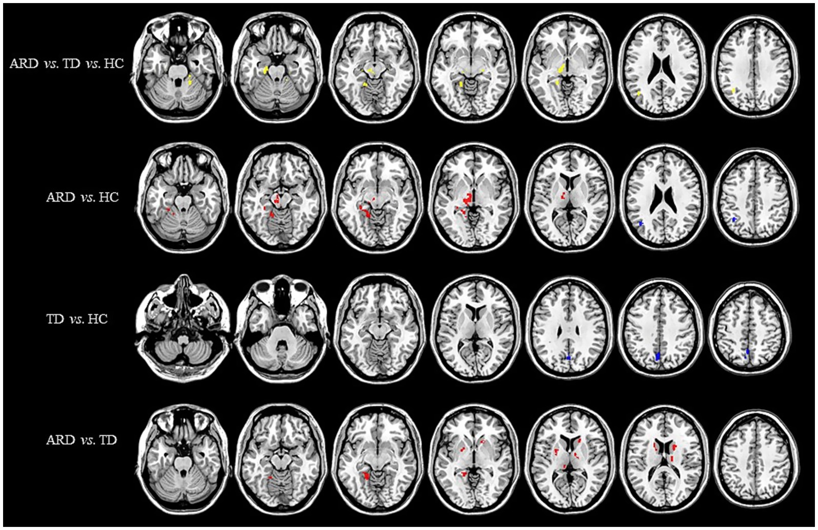 MRI brain scans show four rows with multiple cross-sectional images. Each row compares different groups: ARD vs. TD vs. HC, ARD vs. HC, TD vs. HC, and ARD vs. TD. Colored markers indicate differences in brain regions between groups.