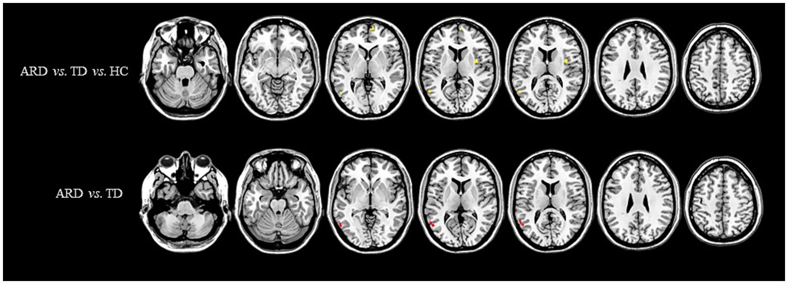 MRI scan comparing brain images across different conditions. The top row labeled