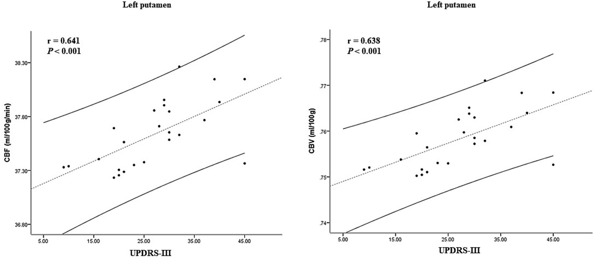 Scatter plots show relationships in the left putamen. The left plot shows CBF (cerebral blood flow) versus UPDRS-III scores with a correlation coefficient of 0.641. The right plot shows CBV (cerebral blood volume) versus UPDRS-III with a correlation of 0.638. Both show significant positive correlations with p-values less than 0.001. Dotted lines represent linear regression; solid lines show confidence intervals.