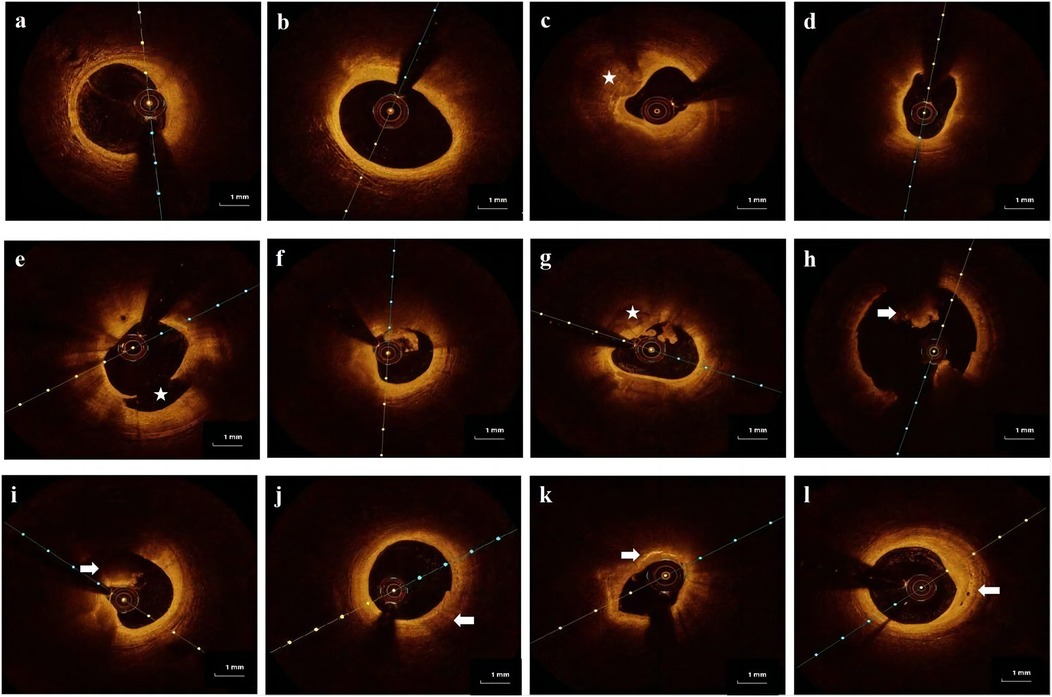 Twelve panels labeled a to l show cross-sectional images of a blood vessel using optical coherence tomography. Each panel displays varying features and formations within the vessel, marked by stars and arrows. The images exhibit different textures, shapes, and areas of interest within a one millimeter scale.
