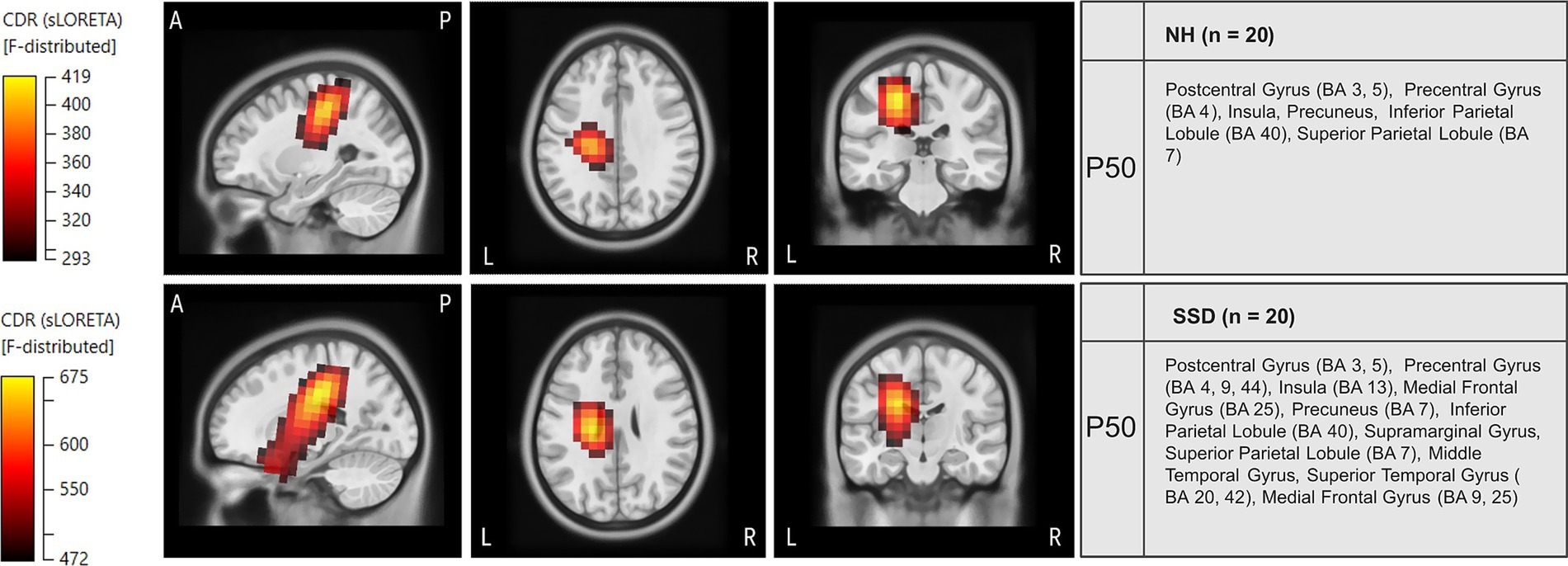 Brain images depicting areas of activity during vibrotactile stimulation for the P50 component in two groups (NH and SSD). The top row shows the NH group, with highlighted regions in sagittal, axial, and coronal views, emphasizing the Postcentral Gyrus. The bottom row presents the SSD group, highlighting more extensive regions, including both the Postcentral Gyrus and the Superior Temporal Gyrus. Color scales on the left represent the intensity levels of activation.