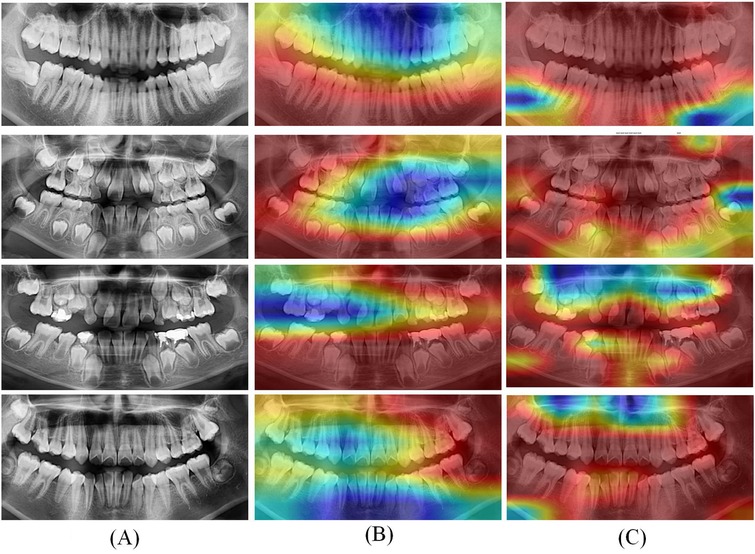 A series of dental X-rays showing images labeled as A, B, and C. The left column displays grayscale X-rays of teeth, while the middle and right columns overlay heatmap colors on the X-rays, highlighting varying areas with colors ranging from blue to red. Each row represents a different set of images, indicating diverse patterns in tooth and jaw structures.