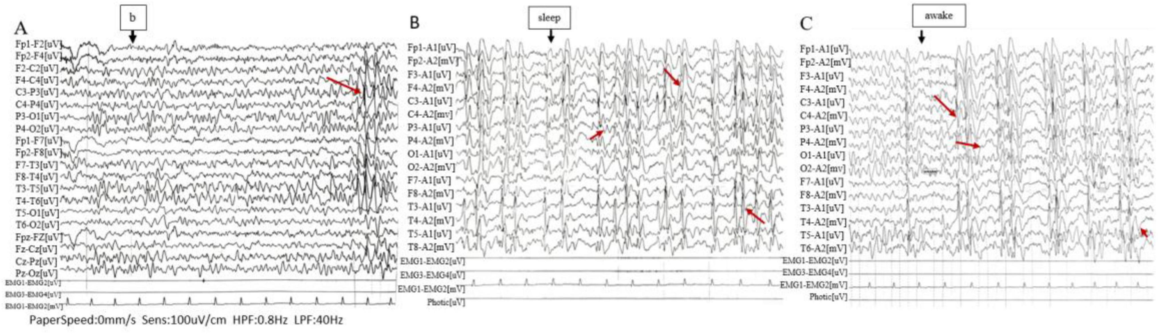 EEG tracings split into three sections labeled A, B, and C. Section A shows slow, high-amplitude waves with an arrow marked. Section B, labeled “sleep,” displays faster frequency waves, also with arrows. Section C, labeled “awake,” shows mixed-frequency waves with several arrows pointing to specific features. Settings at the bottom include paper speed and sensitivity.