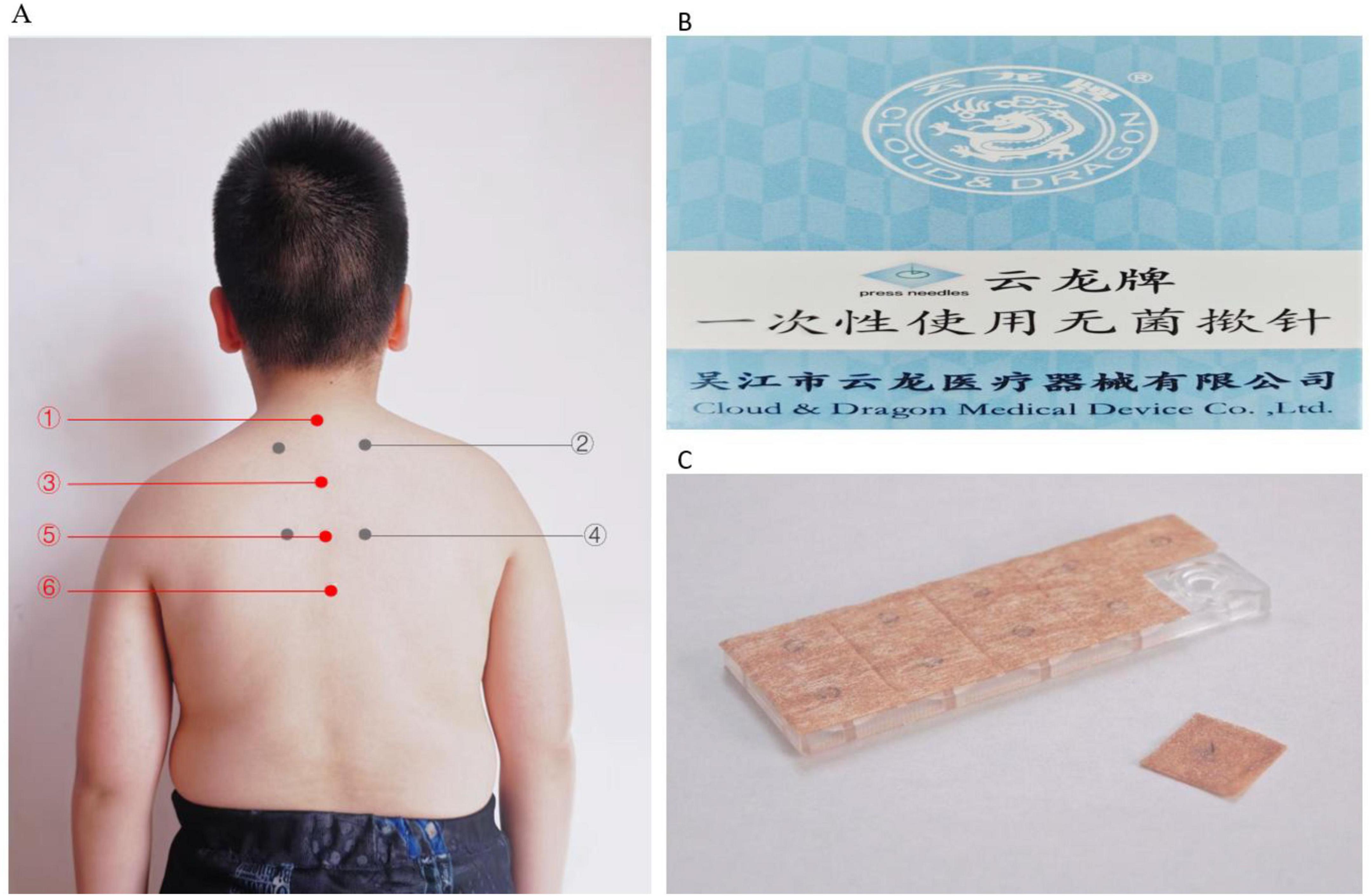 A: A child’s back with six marked acupuncture points highlighted by red and grey circles and numbered lines. B: Packaging labeled in Chinese and English, reading “Cloud & Dragon Medical Device Co., Ltd.” with “press needles” indicated. C: Close-up of a transparent plastic case containing acupuncture press needles, with one needle sheet partially removed.