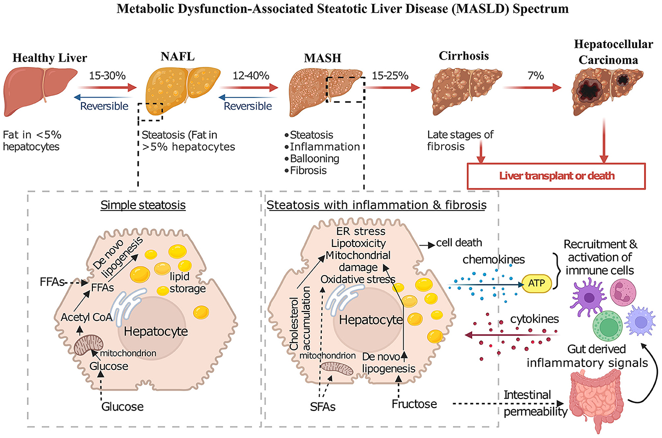 Diagram illustrating the Metabolic Dysfunction-Associated Steatotic Liver Disease (MASLD) spectrum from healthy liver to hepatocellular carcinoma. It includes stages: Healthy Liver, NAFL (non-alcoholic fatty liver), MASH (steatohepatitis), Cirrhosis, and Hepatocellular Carcinoma, with progression percentages and reversibility notes. Insets show cellular processes: Simple steatosis highlights lipid storage and de novo lipogenesis; Steatosis with inflammation and fibrosis emphasizes ER stress, oxidative stress, immune activation, and gut-derived inflammatory signals. Liver transplant or death is indicated as outcomes for severe stages.