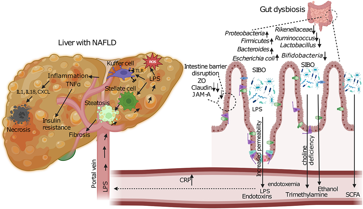 Illustration depicting the interaction between a liver with MASLD and gut dysbiosis. The liver shows necrosis, inflammation with TNF-alpha, steatosis, and fibrosis pathways influenced by insulin resistance and cell responses. The gut section illustrates dysbiosis with changes in bacterial populations and intestinal barrier disruption, leading to increased permeability. Metabolites like LPS, trimethylamine, ethanol, and SCFA are shown entering the bloodstream through the portal vein, contributing to endotoxemia and CRP increase.