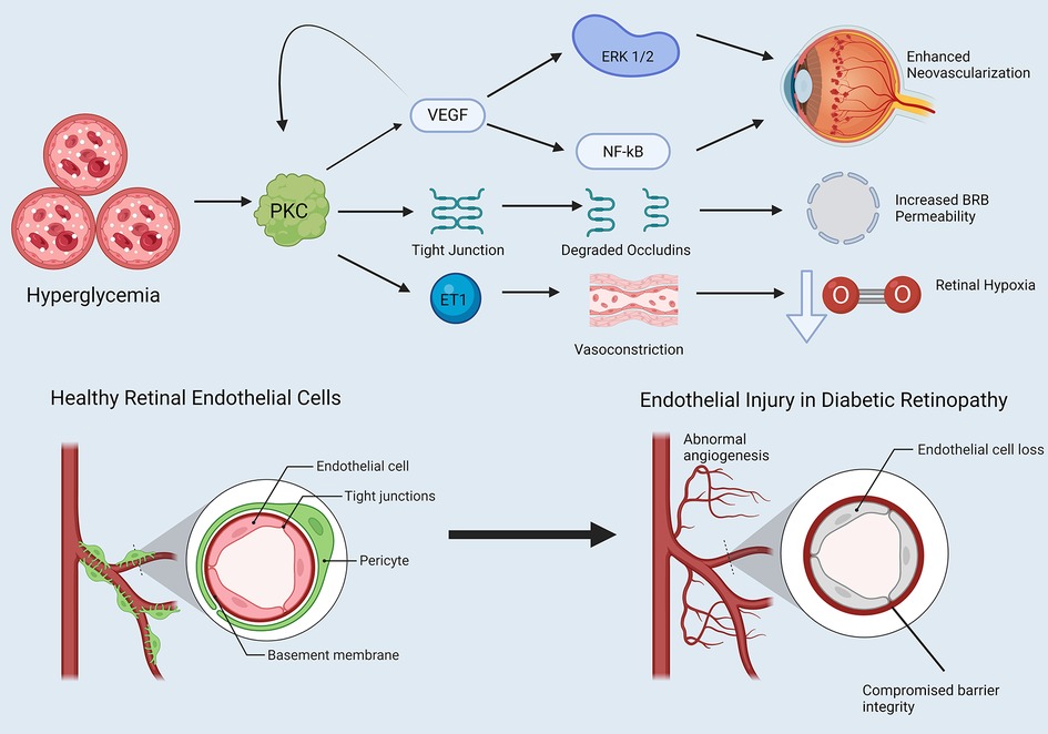 Diagram illustrating the process of endothelial injury in diabetic retinopathy. High blood sugar (hyperglycemia) activates PKC, affecting VEGF, NF-kB, and ET1 pathways. This leads to tight junction degradation, increased BRB permeability, and retinal hypoxia. The comparison between healthy and damaged retinal endothelial cells shows abnormal angiogenesis and compromised barrier integrity due to tight junction and endothelial cell loss.