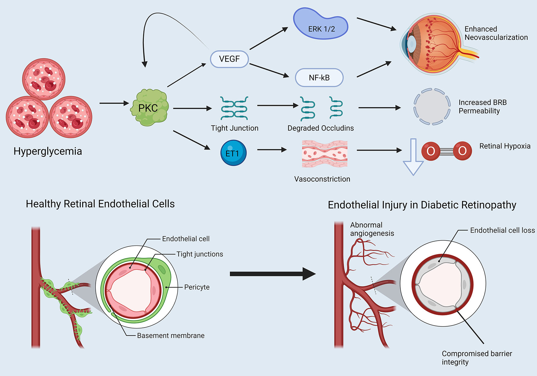 Diagram illustrating the process of endothelial injury in diabetic retinopathy. High blood sugar (hyperglycemia) activates PKC, affecting VEGF, NF-kB, and ET1 pathways. This leads to tight junction degradation, increased BRB permeability, and retinal hypoxia. The comparison between healthy and damaged retinal endothelial cells shows abnormal angiogenesis and compromised barrier integrity due to tight junction and endothelial cell loss.