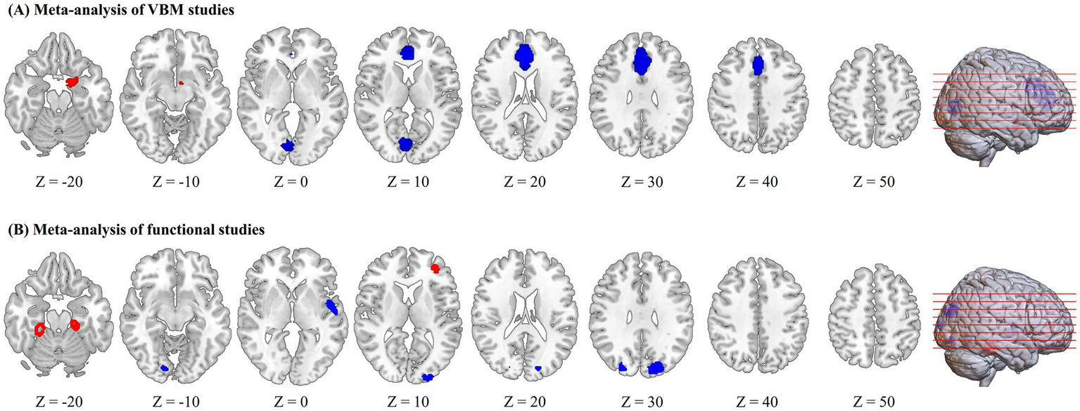 Two sets of brain scans showing meta-analyses. (A) VBM studies highlight blue areas at Z-coordinates 0, 10, 20, 30, and a red area at Z -20. (B) Functional studies display red areas at Z -20 and 10, and blue areas at Z -10, 0, 10, 20, 30. Both sets include a side view with slotted red lines.