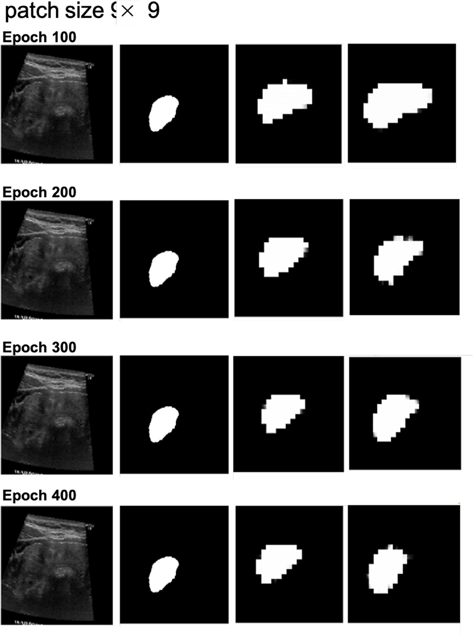 Ultrasound image segmentation progress across four epochs (100, 200, 300, 400) with patch size nine by nine. Each row shows the original ultrasound image followed by three segmentation outputs, illustrating the development in segmentation accuracy and refinement over epochs.