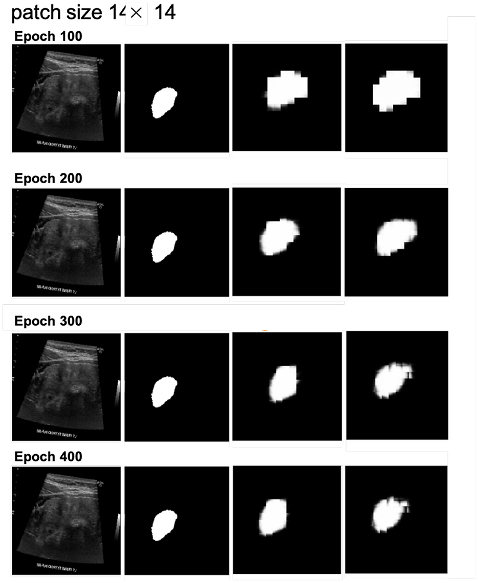 Ultrasound images segmented across four training epochs: 100, 200, 300, and 400. Each row shows an original ultrasound scan followed by three stages of segmentation, illustrating progressive refinement and clarity in the segmented regions with increasing epochs. Patch size is fourteen by fourteen.