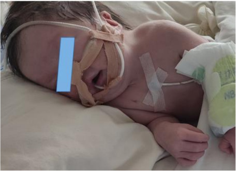 Newborn lying on a bed with medical tubing and adhesive tape on the face and chest. The face is partially obscured for privacy. The infant is wearing a diaper and resting on a soft blanket.