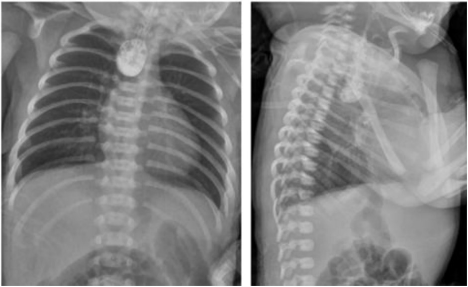 X-ray images show a foreign object, likely a coin, lodged in the esophagus of a young child, viewed from the front and side. The coin appears circular, obstructing the upper esophagus between the visible ribs and spine.