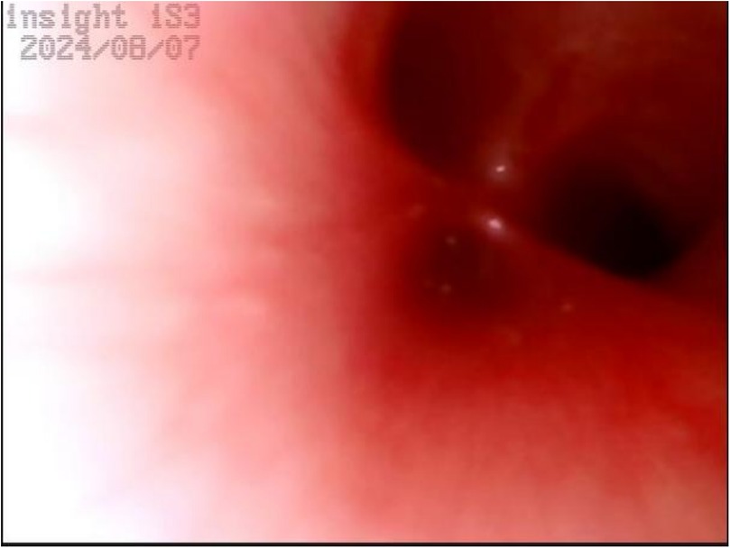 Medical image showing the interior of a reddish passageway, possibly an endoscopic view of part of the digestive tract. The top left corner displays the text \