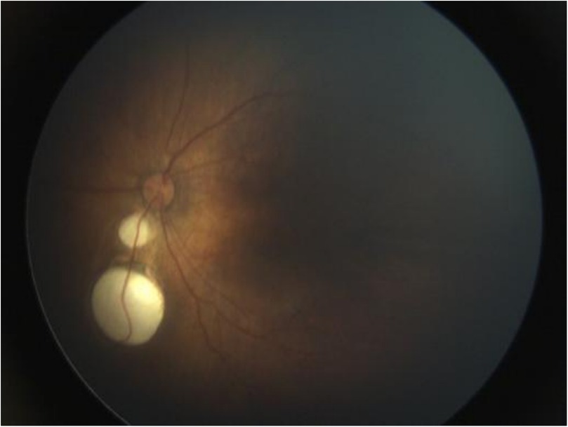 Close-up view of a retina displaying the optic nerve head and blood vessels. An abnormal light-colored area is visible beneath the optic disc, indicating possible pathology. The background appears slightly blurred.