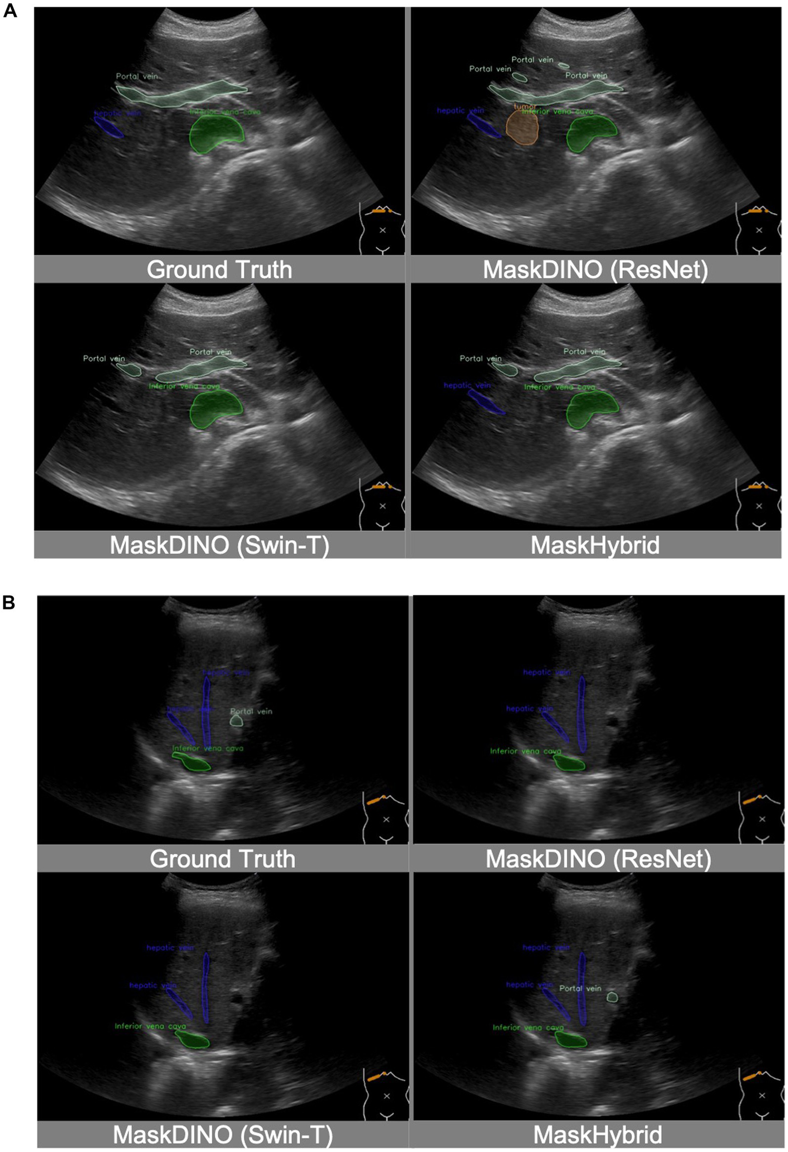 Ultrasound images in two panels labeled A and B show comparisons of various segmentation methods. Each panel contains four ultrasound scans marked as Ground Truth, MaskDINO (ResNet), MaskDINO (Swin-T), and MaskHybrid. Anatomical structures like the portal vein and inferior vena cava are outlined in different colors, highlighting differences in segmentation techniques.