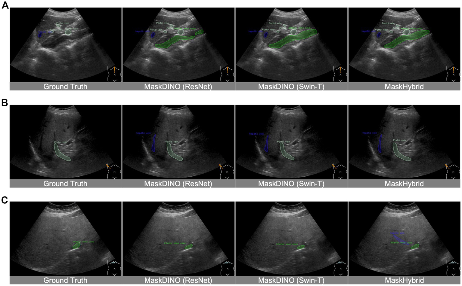 Ultrasound images showing three panels (A, B, C) with four comparisons each: Ground Truth, MaskDINO (ResNet), MaskDINO (Swin-T), and MaskHybrid. Each panel highlights anatomical structures like the portal vein, hepatic vein, and inferior vena cava in green and blue overlays, demonstrating the segmentation results of different AI models.
