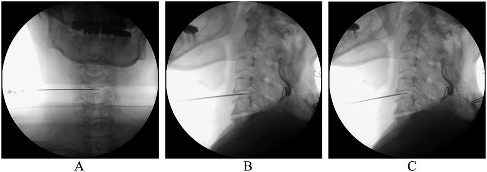 X-ray images labeled A, B, and C show a sequential process involving a needle insertion in the cervical spine area. Each image reveals the needle's progression and placement relative to the spinal structures.