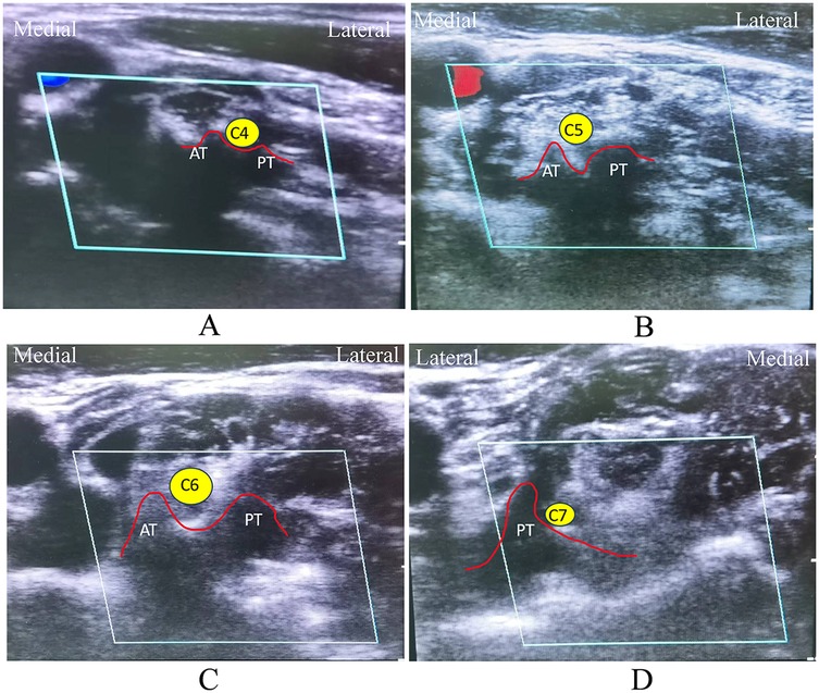 Ultrasound images labeled A to D show cross-sections of the cervical vertebrae, highlighting the C4, C5, C6, and C7 vertebrae with red and yellow markers. The anterior tubercle (AT) and posterior tubercle (PT) are marked, with medial and lateral directions indicated.