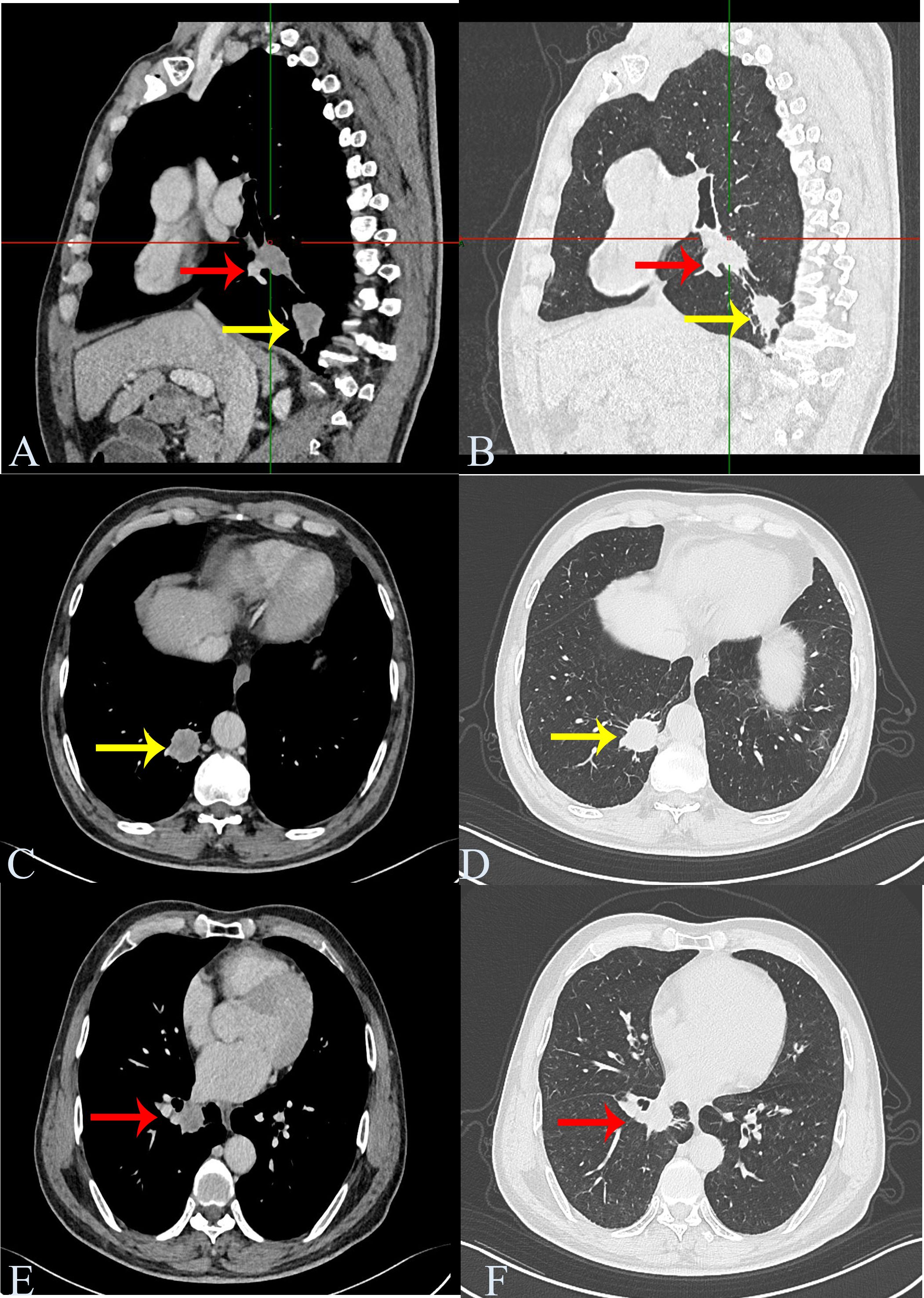 CT scans showing the chest region in both sagittal and axial views, labeled A to F. Arrows indicate specific areas of interest. Panels A and B highlight regions with red and yellow arrows. Panels C and D display axial views with yellow arrows pointing to distinct features. Panels E and F also show axial views with red arrows marking areas within the lung region.