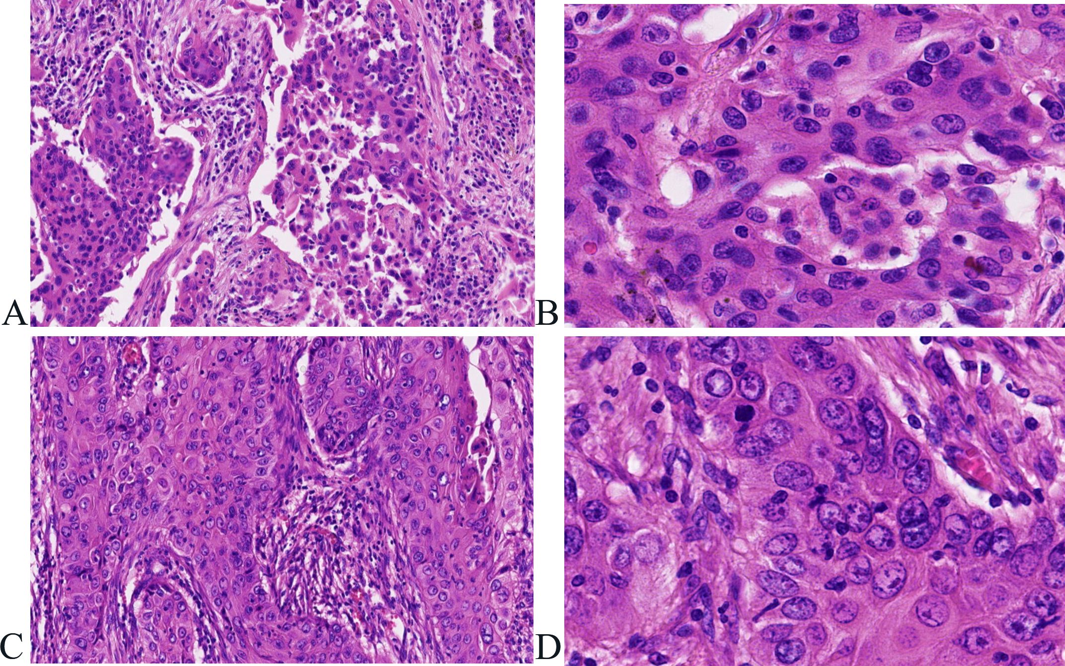 Histological analysis showing four panels of tissue samples stained with hematoxylin and eosin. Panel A exhibits dense cellular regions with some clear spaces. Panel B highlights closely packed cells with prominent nuclei. Panel C shows swirling patterns of cells with varying density. Panel D features enlarged, irregularly shaped cells with distinct nuclear details.