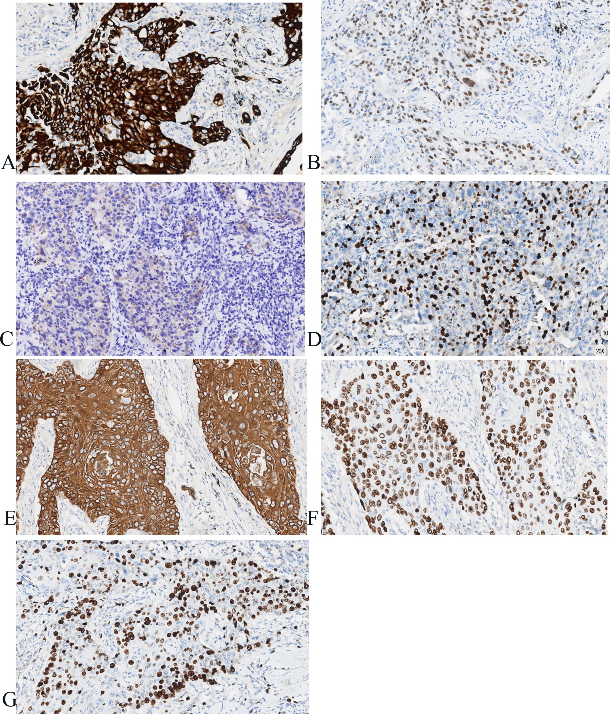 Histological slides show various levels of staining and cellular distribution. A: Dense brown staining indicating high expression. B: Lighter, patchy staining. C: Blue cellular details with minimal staining. D: Moderate, uniform brown staining. E: Strong, concentrated brown staining in glandular structures. F: Brown staining with nuclei visible. G: Scattered brown staining throughout.
