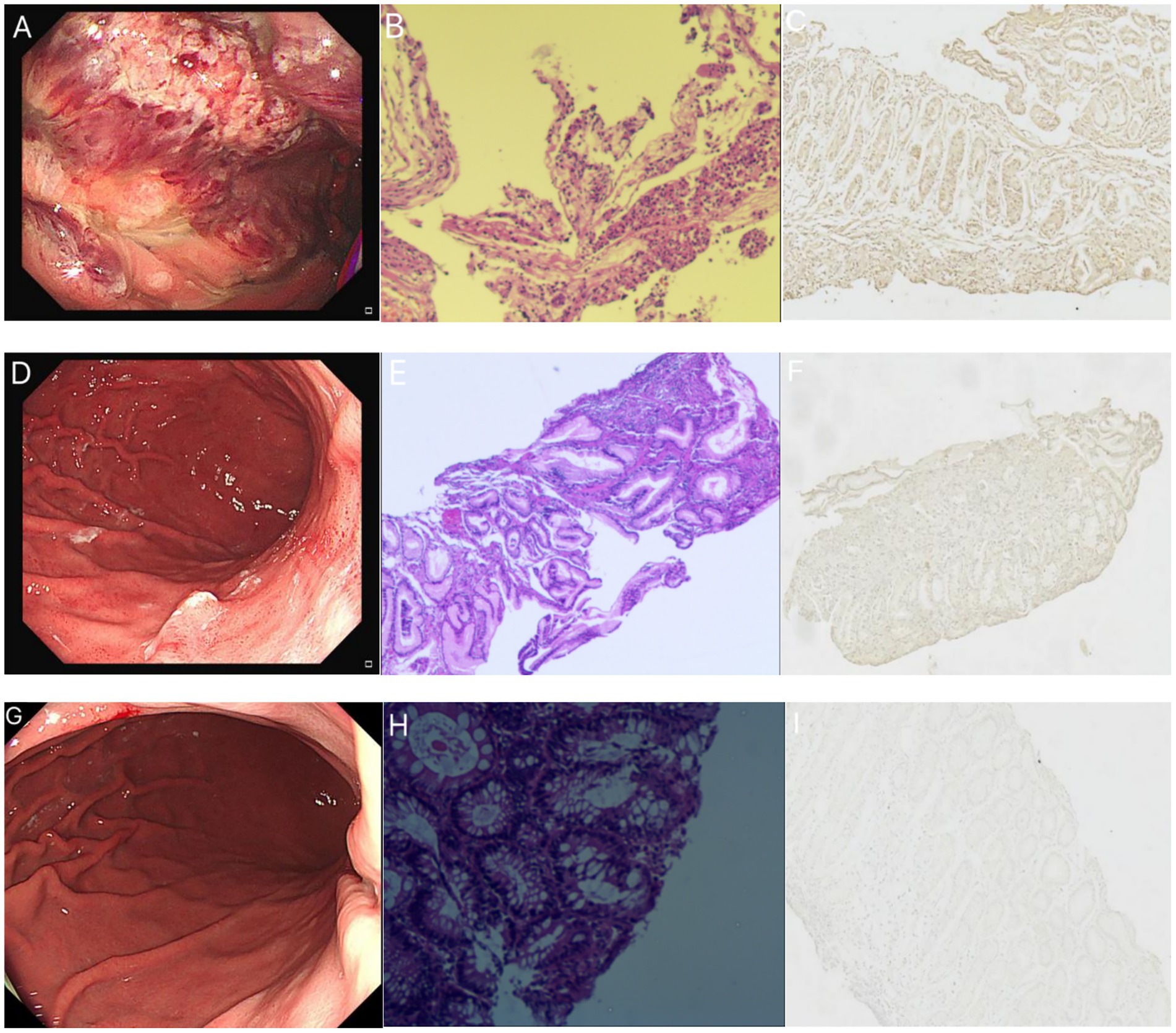 Panel of nine images showing endoscopic and histological views. A, D, and G depict endoscopic views of the gastrointestinal tract, with varying redness and texture. B, E, and H are histological sections stained to highlight tissue structures, with varying degrees of detail and color intensity. C, F, and I are histological sections after immunohistochemistry, showing the comparison of positive expression in tissues at different stages.