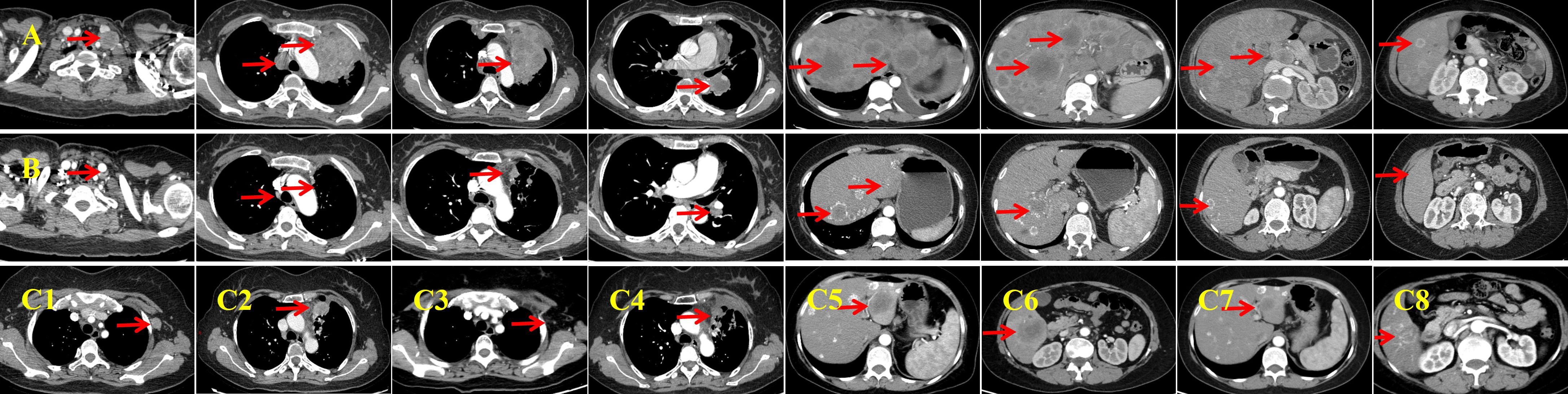 CT scan images arranged in three rows and eight columns, labeled A, B, and C1 to C8. Each image shows cross-sectional views of the thorax and abdomen with red arrows pointing to specific areas of interest. Yellow labels identify each section clearly.