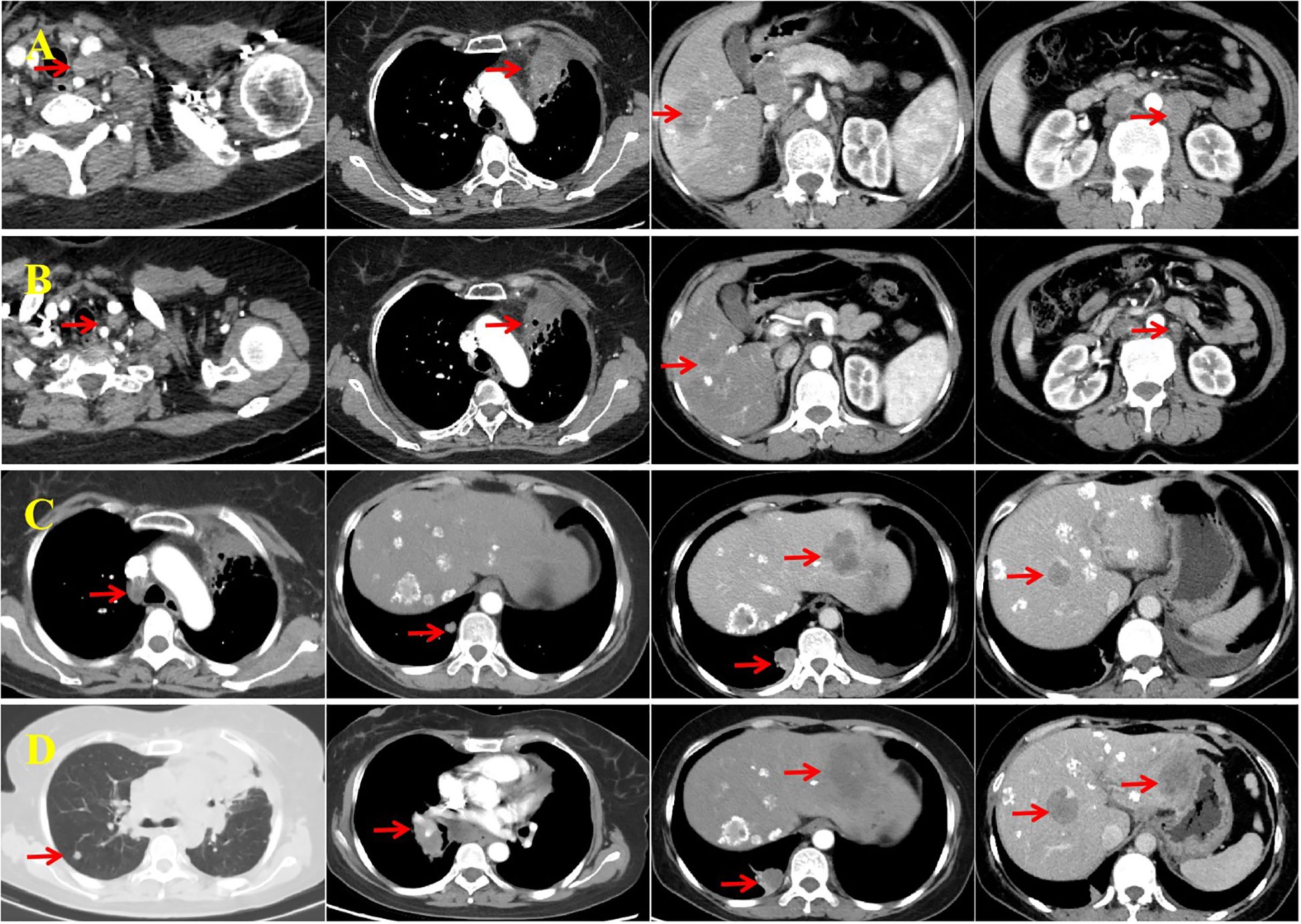 Four panels labeled A to D, each with a series of medical scans marked by red arrows. Panel A shows images of the neck, chest, and abdomen. Panel B depicts chest and abdominal scans. Panel C focuses on the chest and liver. Panel D includes chest and abdominal images, highlighting areas of interest with arrows.
