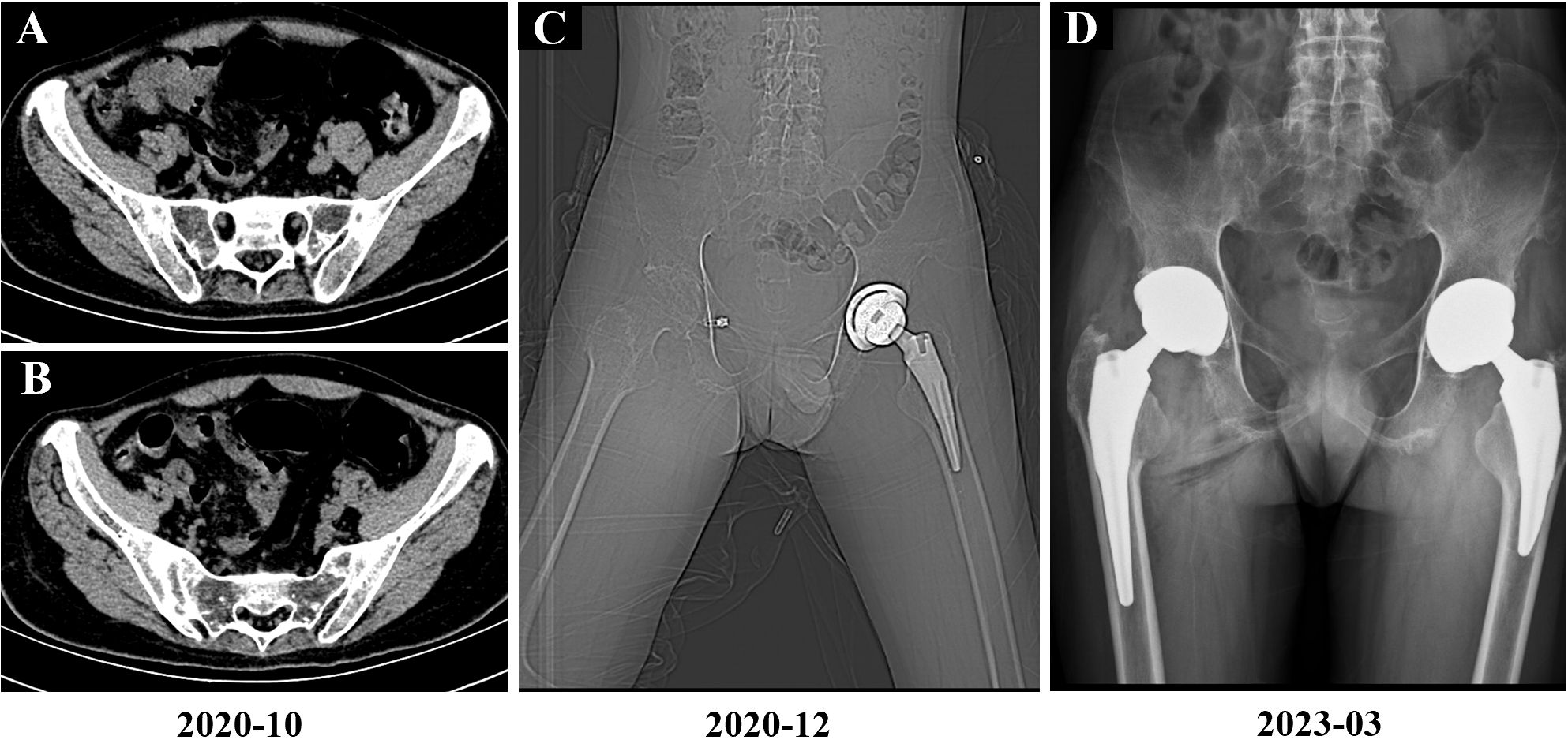 Four-panel medical imaging showing the progression of hip replacements. Panel A and B depict pelvic CT scans from October 2020. Panel C shows an X-ray of a single hip replacement from December 2020. Panel D illustrates dual hip replacements from March 2023.