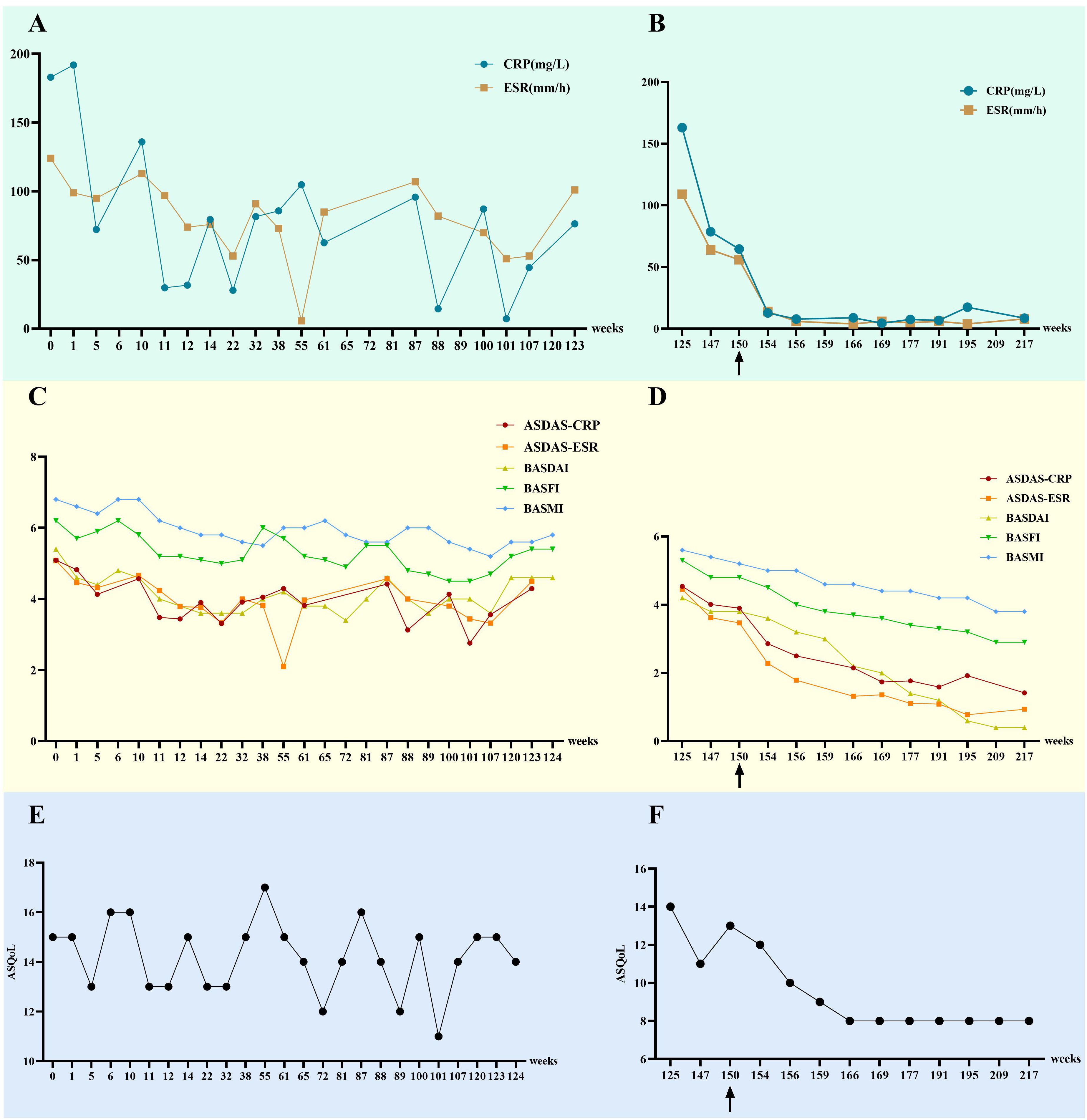 Graphs showing clinical measures over time. Graph A: CRP and ESR levels fluctuate from weeks 0 to 123. Graph B: CRP and ESR levels decline sharply after week 125. Graph C: ASDAS-CRP, ASDAS-ESR, BASDAI, BASFI, and BASMI scores are shown over weeks 0 to 124. Graph D: These same scores decrease after week 125. Graph E: ASDAS score fluctuates between weeks 0 to 124. Graph F: ASDAS score decreases significantly after week 125. Arrows indicate significant events or interventions.