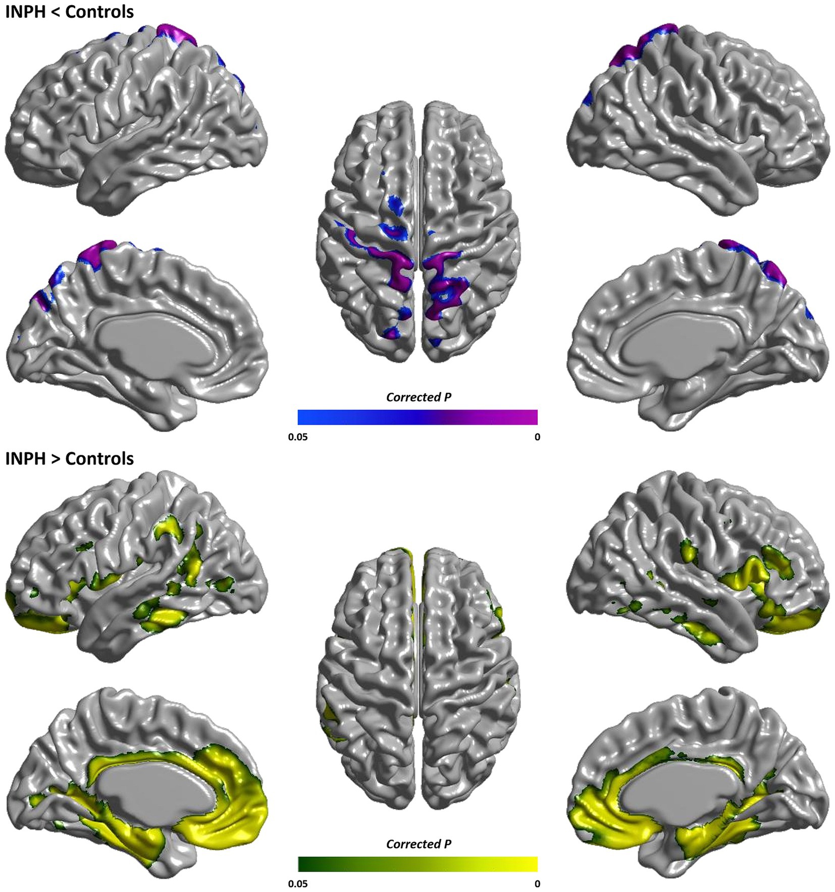 Brain imaging comparison of INPH and control subjects. The top row shows areas where control brains exhibit more activity than INPH, highlighted in blue to magenta. The bottom row shows areas where INPH brains exhibit more activity, highlighted in green to yellow. Both rows feature lateral and top views of the brain, with a color bar indicating corrected P-values from zero to 0.05.