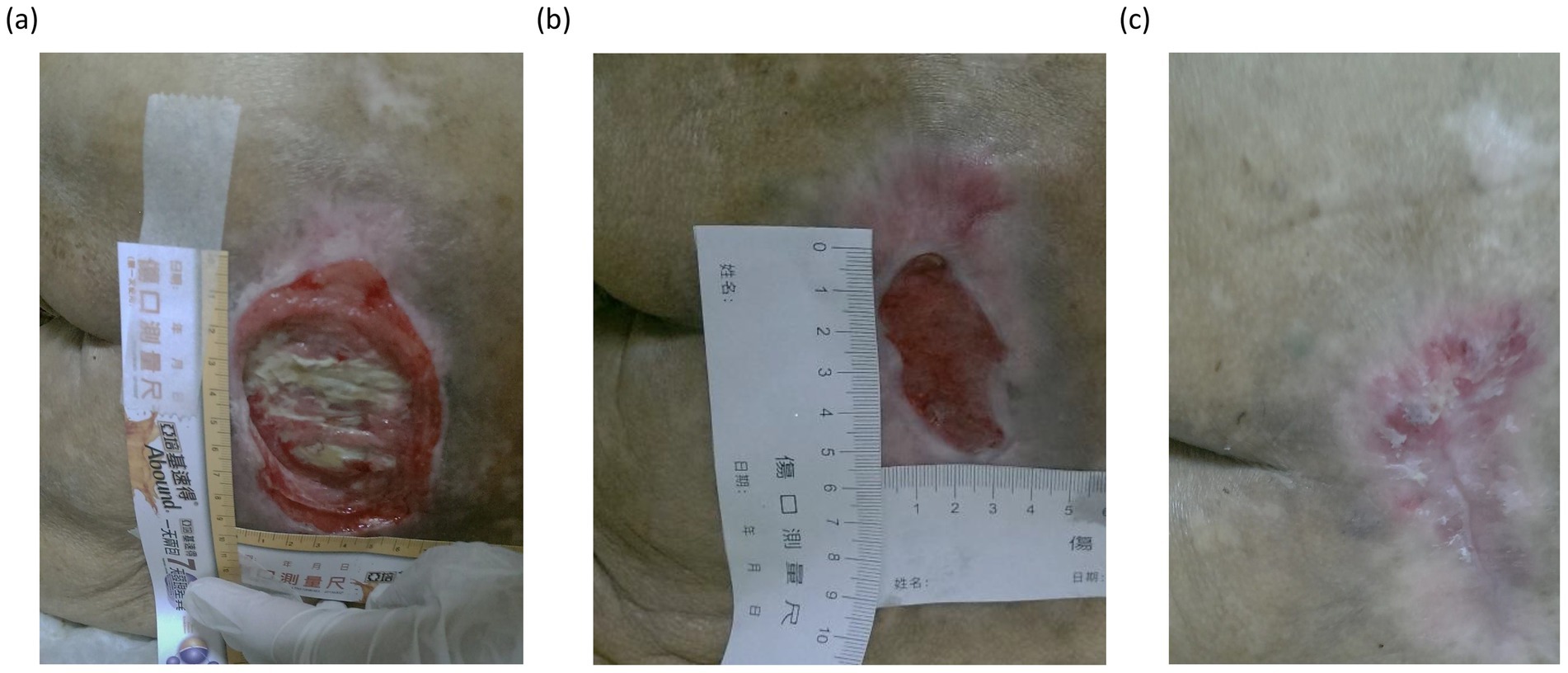 Three-panel image showing the healing progression of a wound on skin. Panel (a) displays a large, open wound with a ruler for measurement. Panel (b) shows the wound partially healed, with reduced size. Panel (c) displays significant healing with scar tissue and minimal open area.