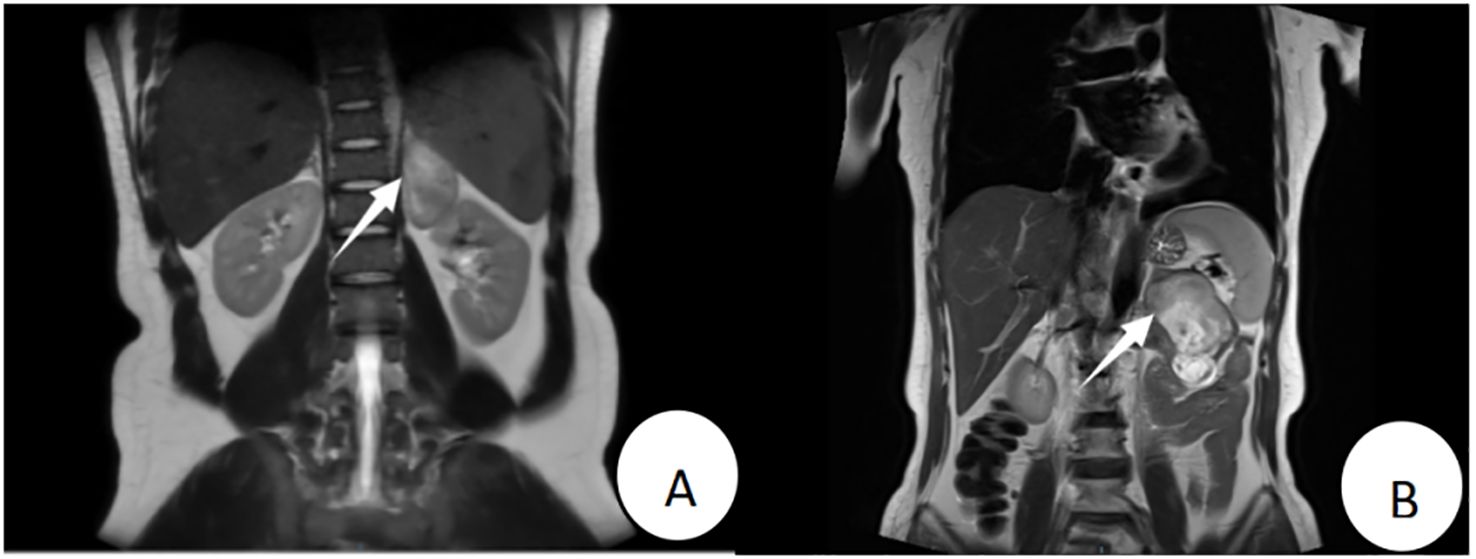 MRI images labeled A and B. Image A shows a coronal view with an arrow pointing to a spinal region. Image B shows a different spinal area, also marked by an arrow, possibly indicating a lesion or anomaly.