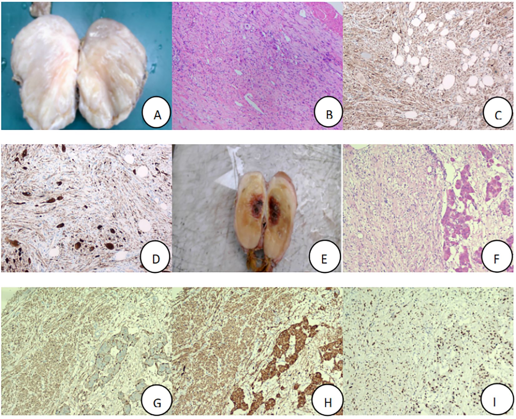 Panel of nine images labeled A to I. A and E show sliced specimens with distinct sections. B, C, D, F, G, H, and I depict histological slides with varying textures and stains. Each slide exhibits unique cellular structures, likely representing different tissue samples or conditions, highlighting variations in density and staining patterns.