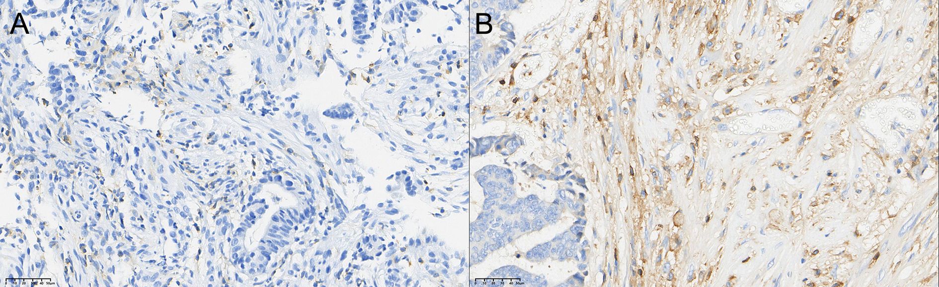 Side-by-side comparison of CD4+ TIL infiltration in rectal cancer tissue before and after neoadjuvant combination therapy. Panel A shows the infiltration grades before therapy, with most patients exhibiting low infiltration (Grade 1). Panel B shows that after therapy, the number of patients with low infiltration decreased, while Grade 2 and Grade 3 infiltration increased, with the change being statistically significant (P < 0.05). A 50-micrometer scale bar is included.
