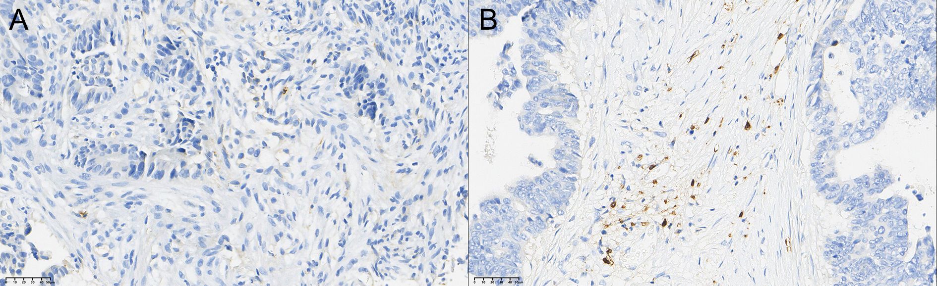 Side-by-side comparison of CD56+ TIL infiltration in rectal cancer tissue before and after neoadjuvant combination therapy. Panel A shows that most patients had low infiltration (Grade 1) before therapy. Panel B shows that after therapy, low infiltration decreased, while Grade 2 and Grade 3 infiltration increased, with the change being statistically significant (P < 0.05). A scale bar is included.