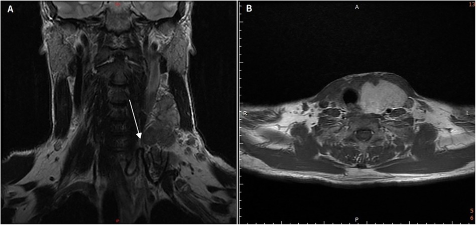 MRI images showing two views of the neck. Panel A is a coronal view with an arrow pointing at a dark area, possibly indicating a structure or anomaly. Panel B is an axial view showing cross-sectional anatomy. Both images display soft tissue and bone contrast.