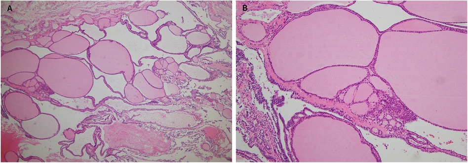 Histological images labeled A and B show cross-sections of adipose tissue. Image A displays a network of large and small fat cells with thin connecting strands. Image B shows an enlarged view with clearer cell boundaries and denser connective tissue. Both images are stained, highlighting the cellular structures in pink and purple.