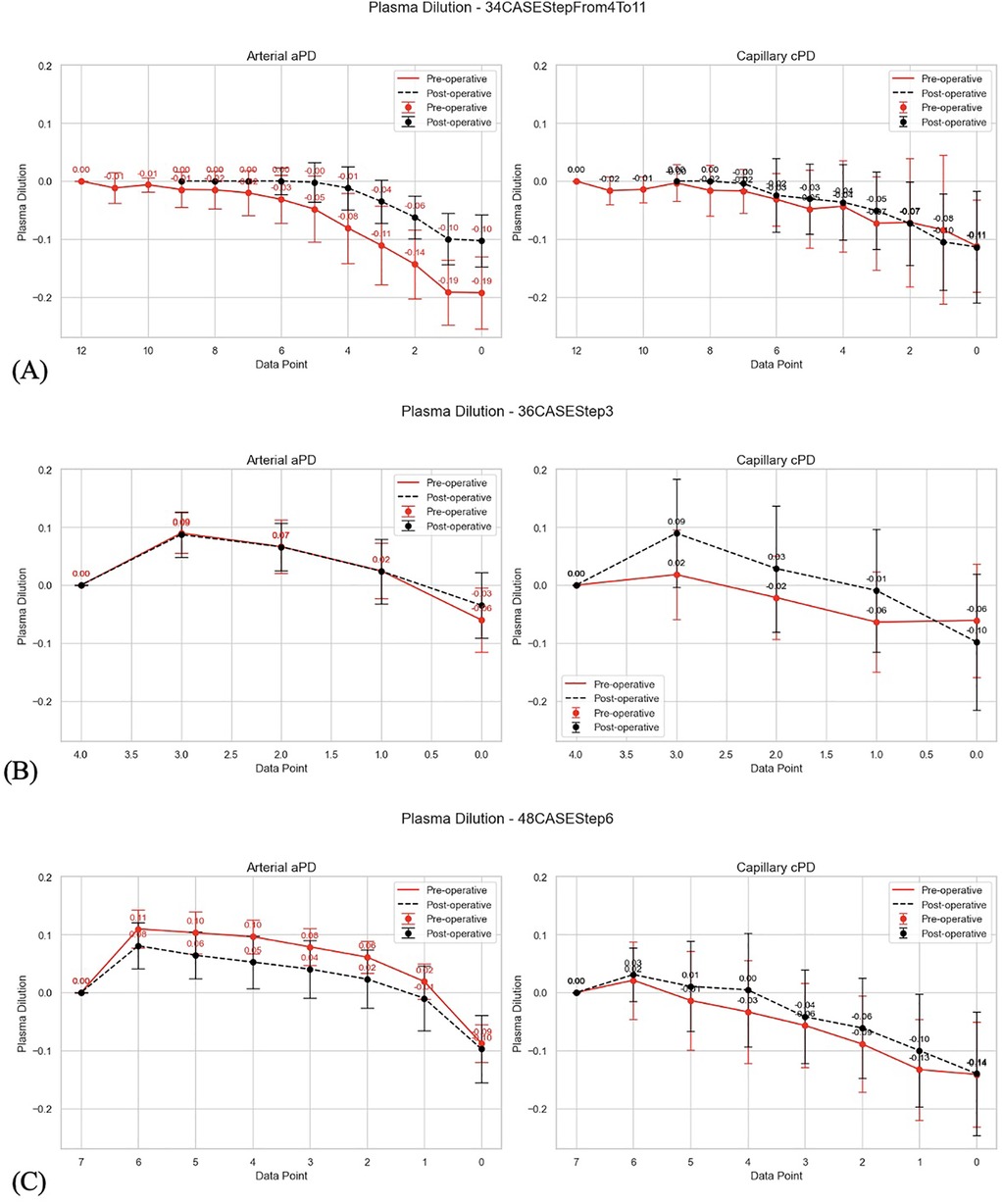Graphs display plasma dilution measurements from three separate cases labeled A, B, and C. Each case includes two graphs: one for arterial (aPD) and one for capillary (cPD) plasma dilution. The graphs compare pre-operative and post-operative data using red and black lines, with error bars indicating variability. The x-axis represents data points, and the y-axis shows plasma dilution levels. Trends vary between cases, with specific numerical annotations on each point.