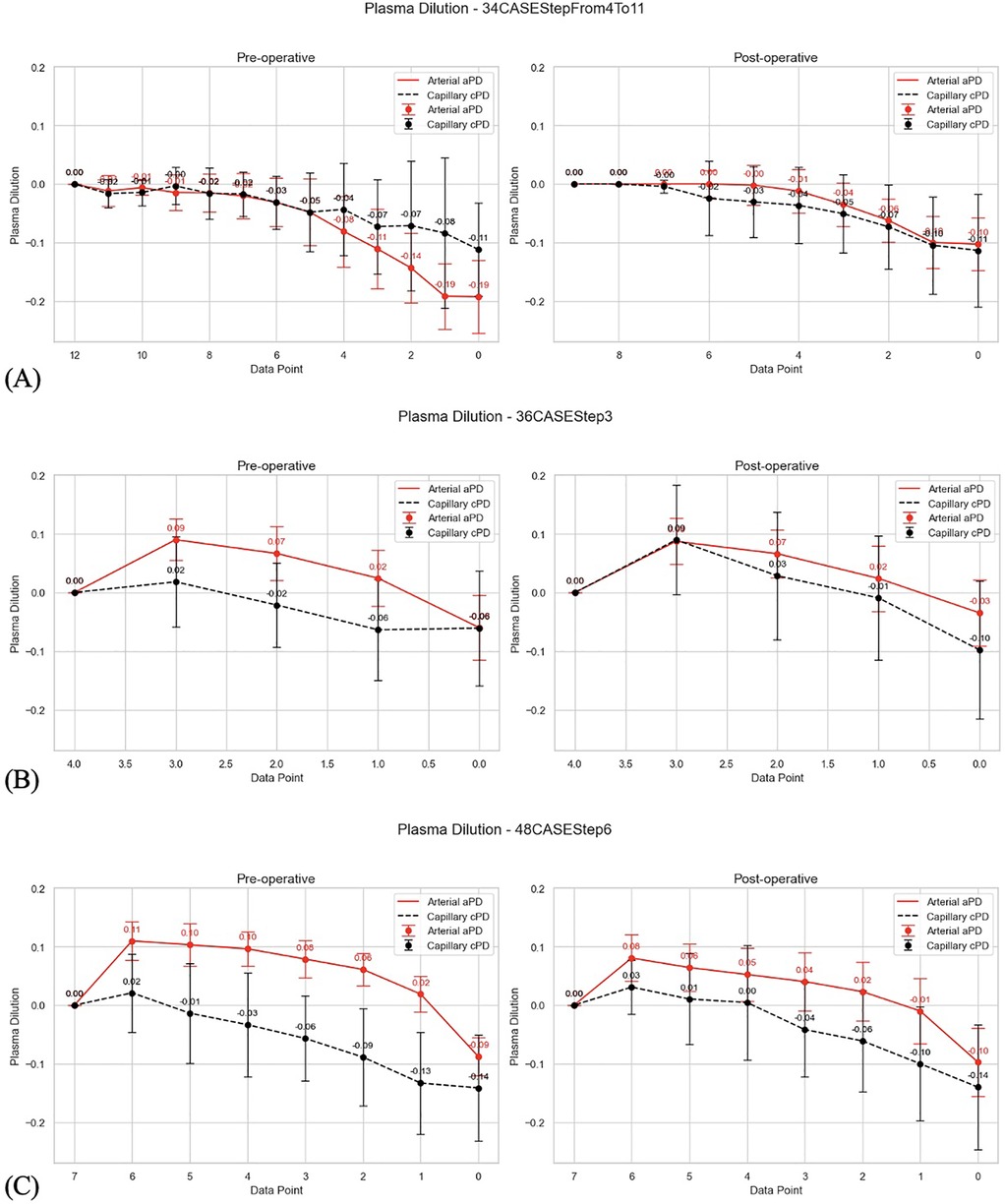 Graphs illustrating plasma dilution over time for different cases. Each section, labeled A, B, and C, includes two graphs showing pre-operative and post-operative data. The x-axes represent data points while the y-axes indicate plasma dilution levels. Red lines represent arterial aPD, black lines capillary cPD, with markers denoting data points and error bars indicating variability.