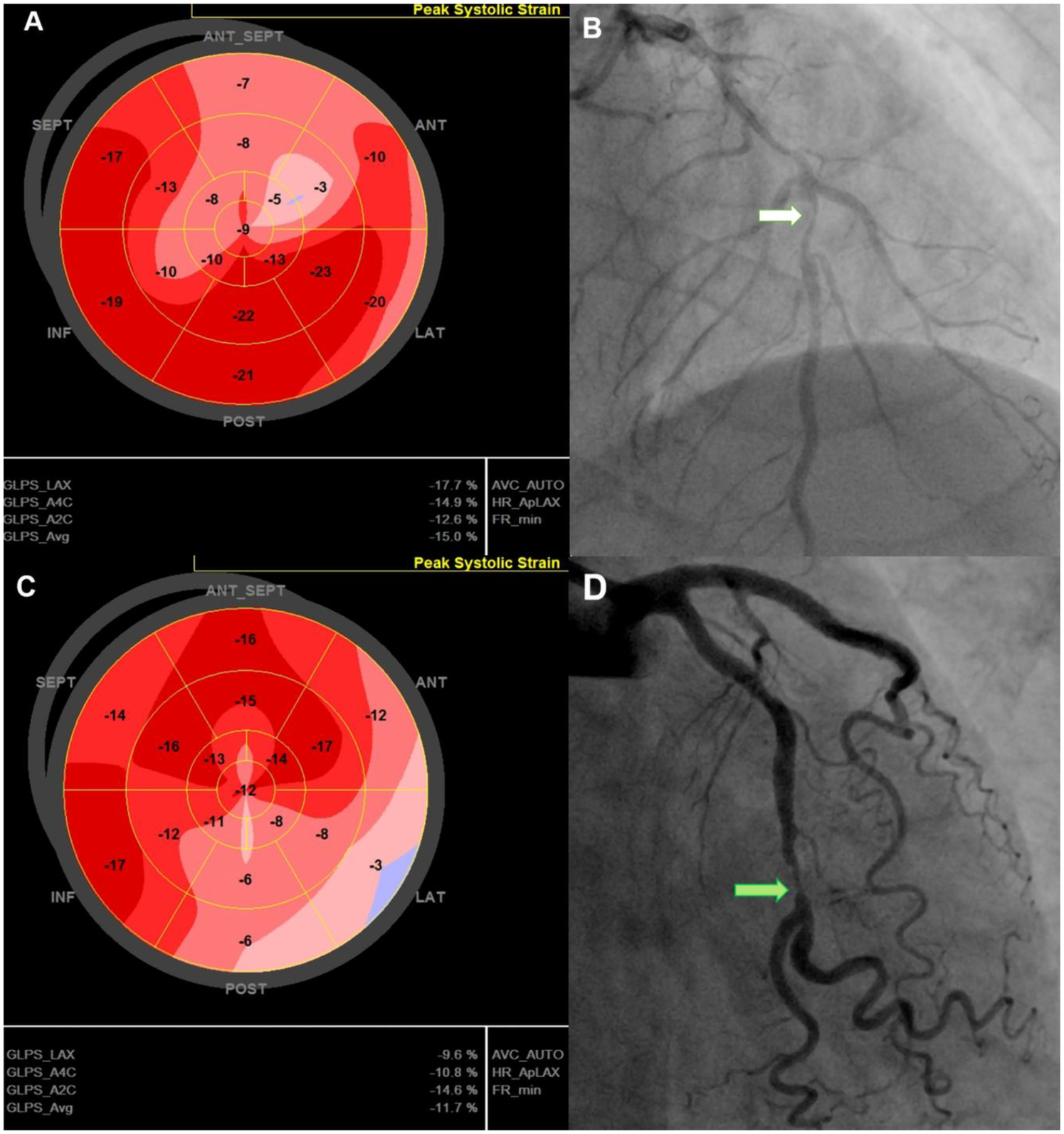 Panel A shows a bullseye plot depicting peak systolic strain with varying shades of red representing different strain levels. Panel B presents a coronary angiogram with an arrow pointing to a vessel. Panel C displays another bullseye plot with strain values similar to Panel A. Panel D shows another angiogram with an arrow highlighting a coronary artery section.