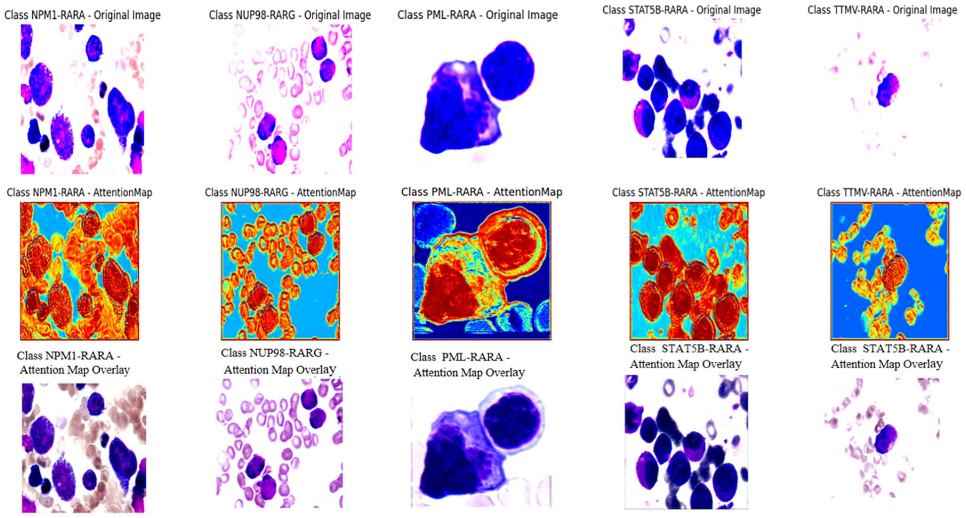 Original and attention map images for five different classes: NPM1-RARA, NUP98-RARG, PML-RARA, STAT5B-RARA, and TTMV-RARA. Each class shows a microscopic original image above and a corresponding attention map below, highlighting different areas of focus in vibrant colors.