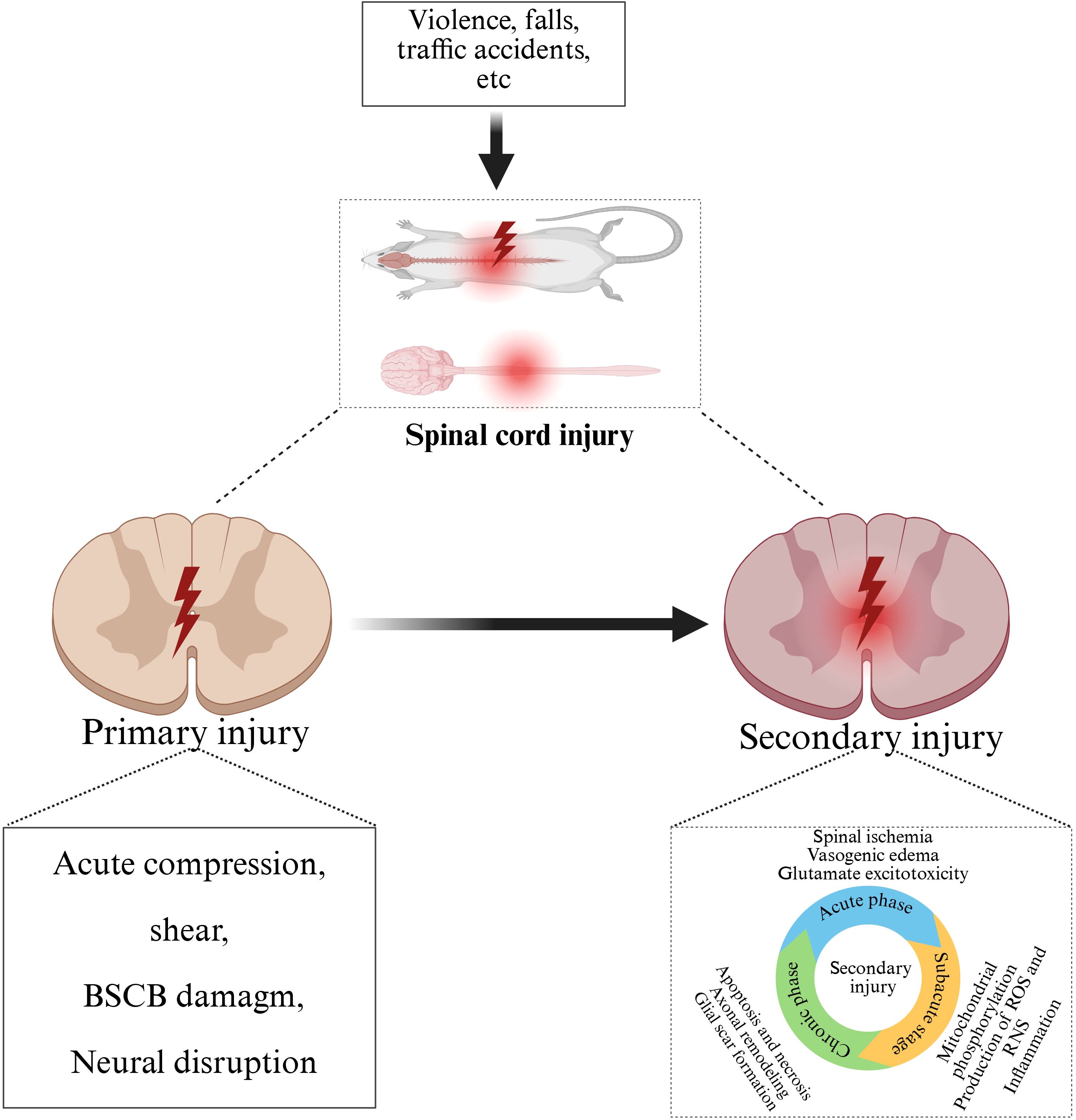 Flowchart illustrating spinal cord injury progression. Causes include violence and accidents, leading to primary injuries like compression and neural disruption. This progresses to secondary injuries, involving spinal ischemia and inflammation.