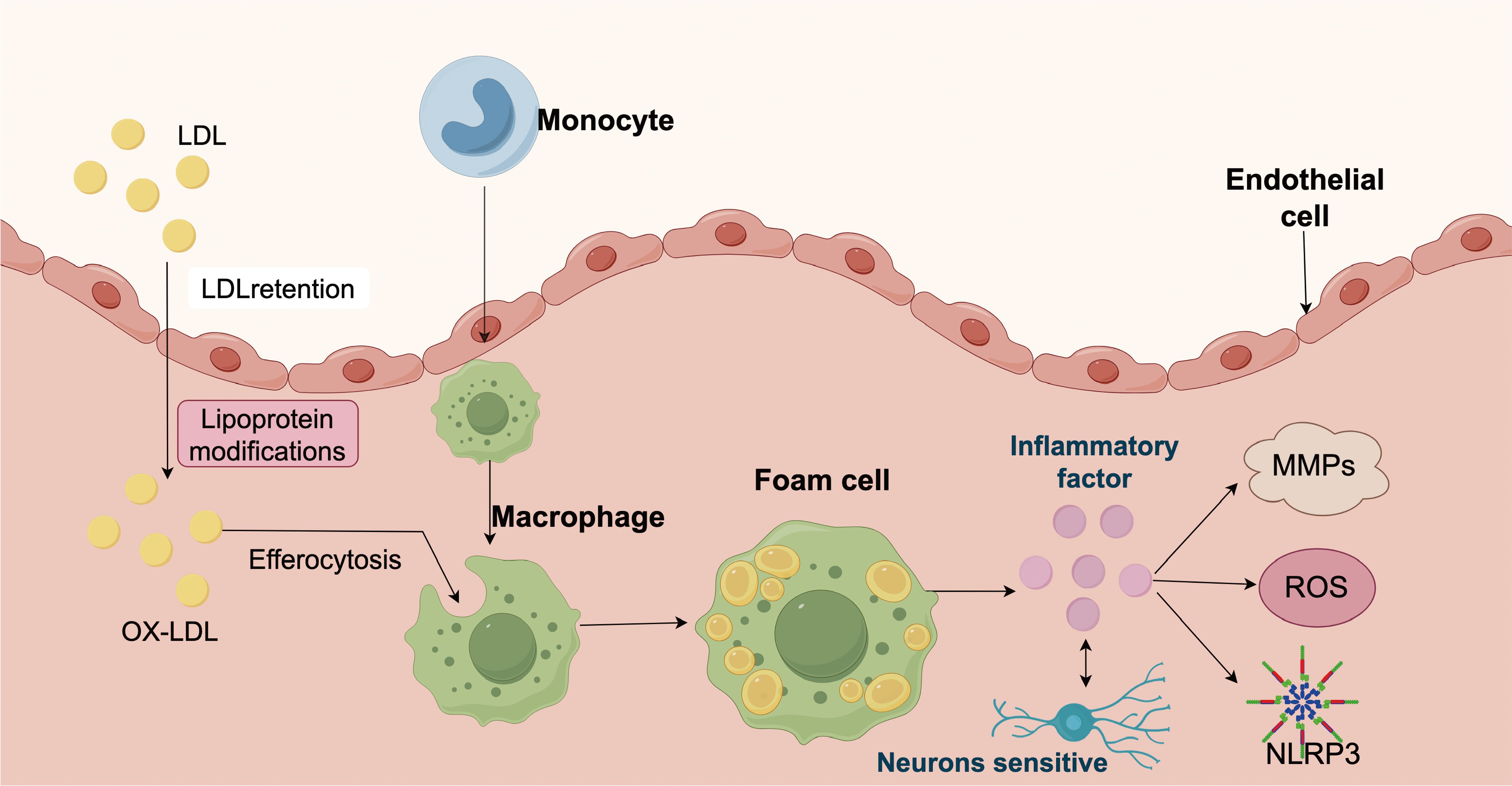 Diagram illustrating the process of atherosclerosis. Low-density lipoprotein (LDL) particles are retained and modified to oxidized LDL (OX-LDL). Monocytes transform into macrophages, which absorb OX-LDL, becoming foam cells. These cells contribute to the release of inflammatory factors like MMPs, ROS, and NLRP3, affecting endothelial cells and neurons.