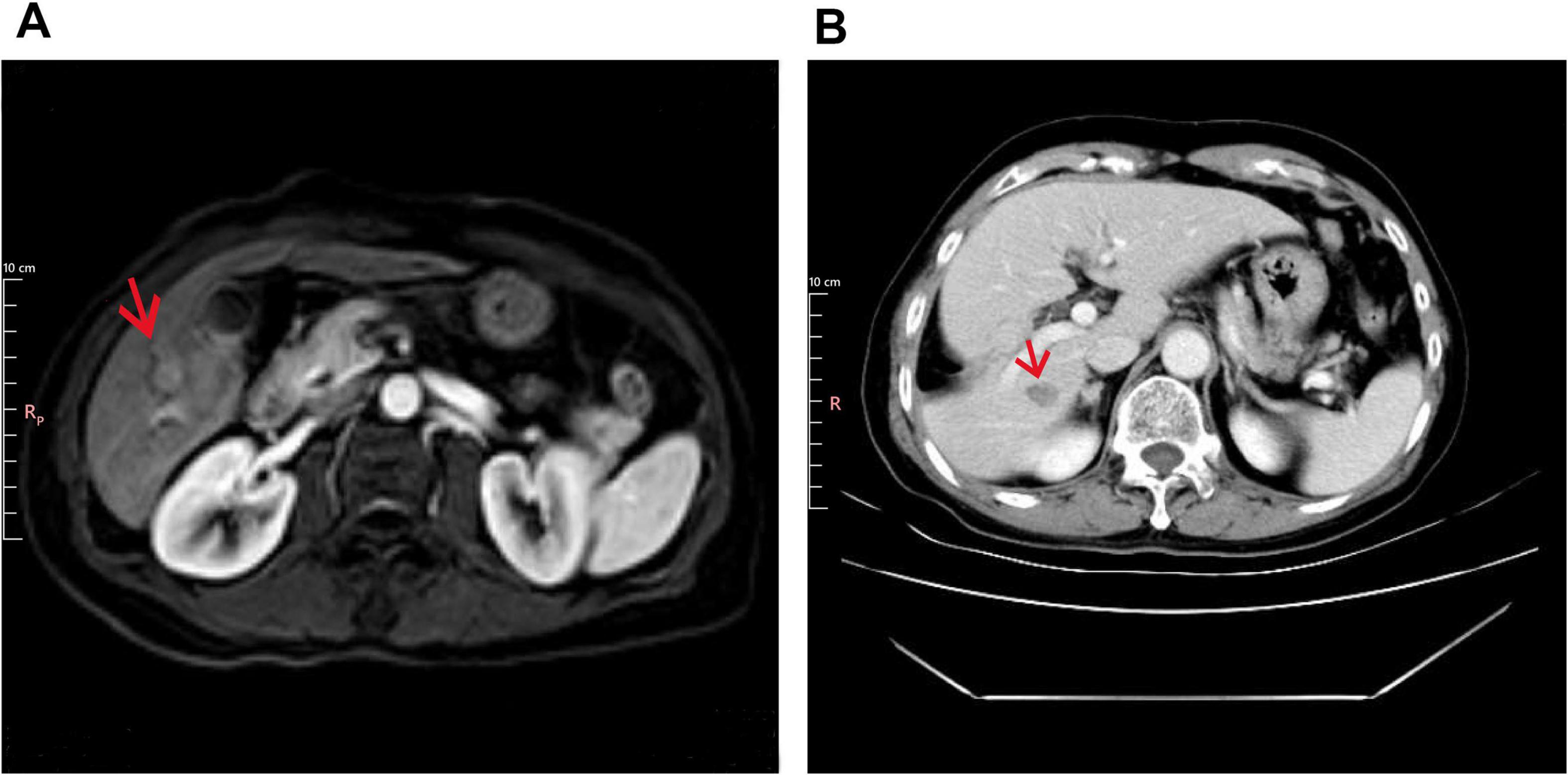MRI and CT scans of an abdomen, labeled A and B. In both images, a red arrow points to an area of interest near the kidney, indicating a possible abnormality. The scans show typical anatomical features with varying shades of gray.